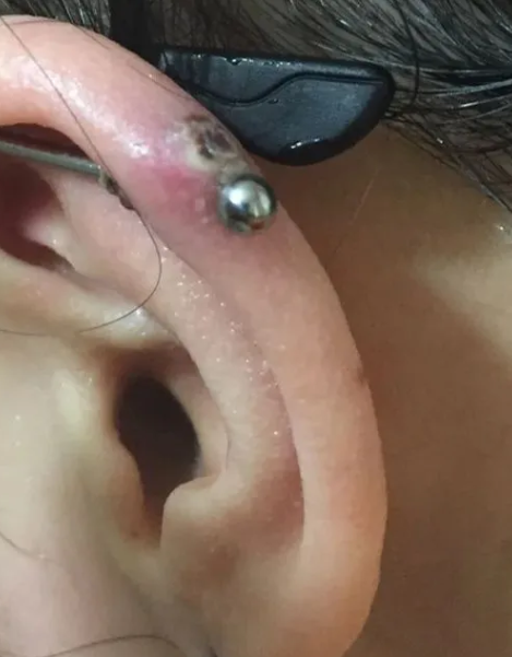 Piercing-στην εφηβεία-Σκουλαρίκι-σε μύτη-αυτιά-γλώσσα-κίνδυνοι-επιπλοκές-