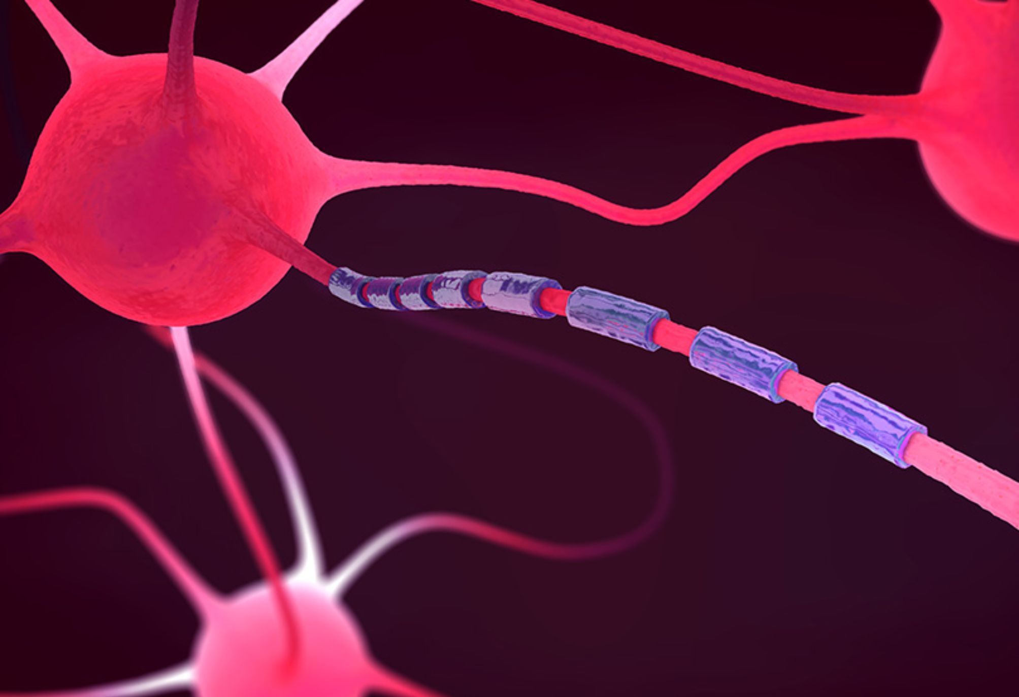 Ζαλάδα θολούρα στο μάτι και πονοκέφαλος: Συμπτώματα της Σκλήρυνσης κατά πλάκας