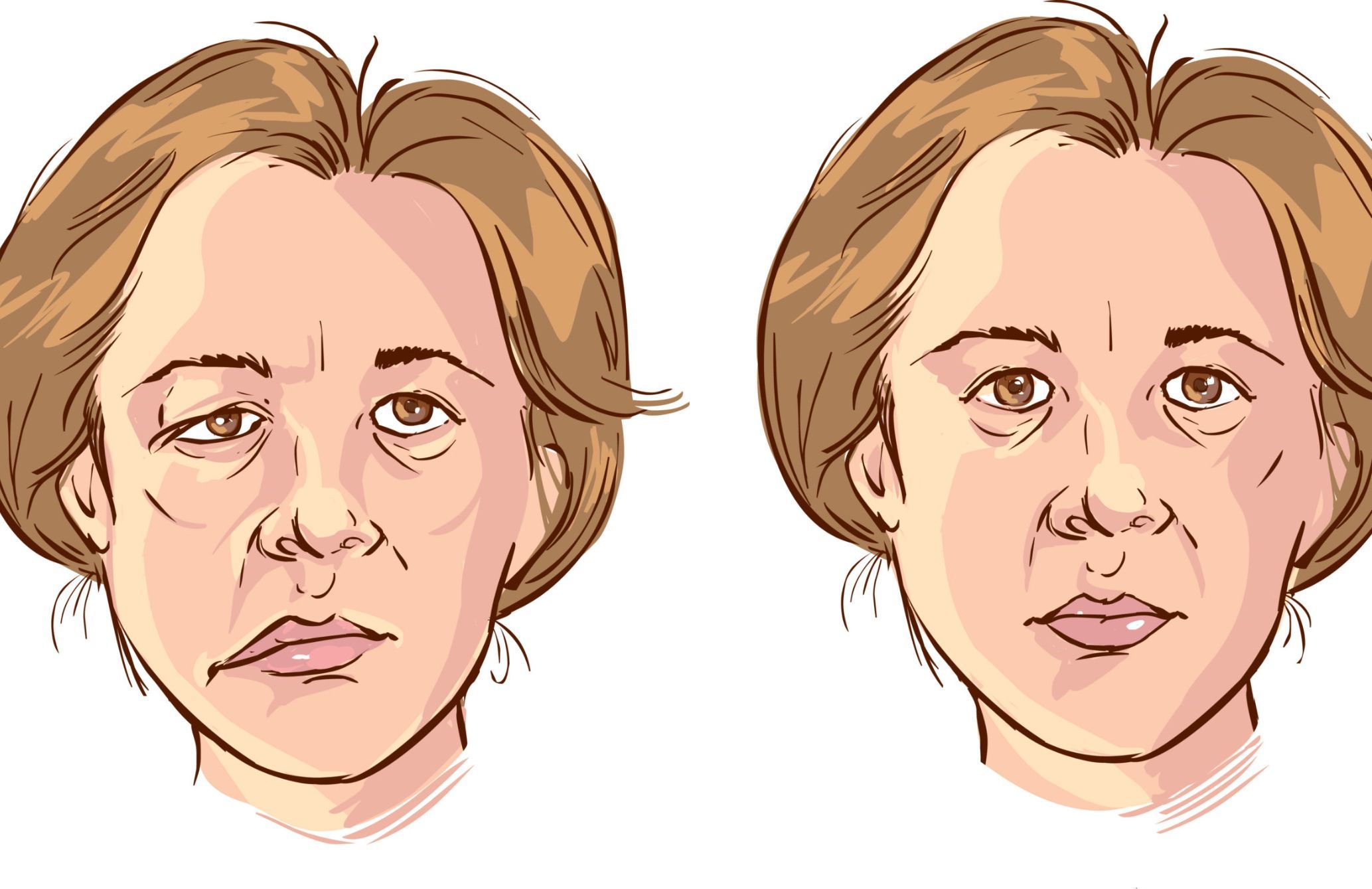 Πάρεση προσώπου: Τι μπορεί να την προκαλέσει και ποια τα συμπτώματα