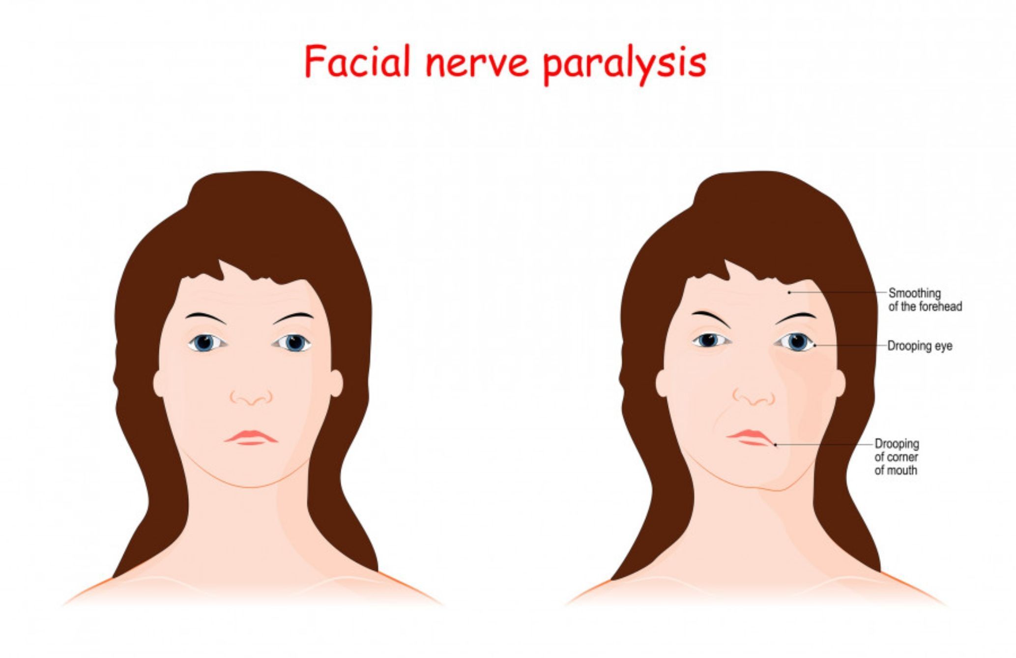 Πάρεση προσώπου: Τι μπορεί να την προκαλέσει και ποια τα συμπτώματα