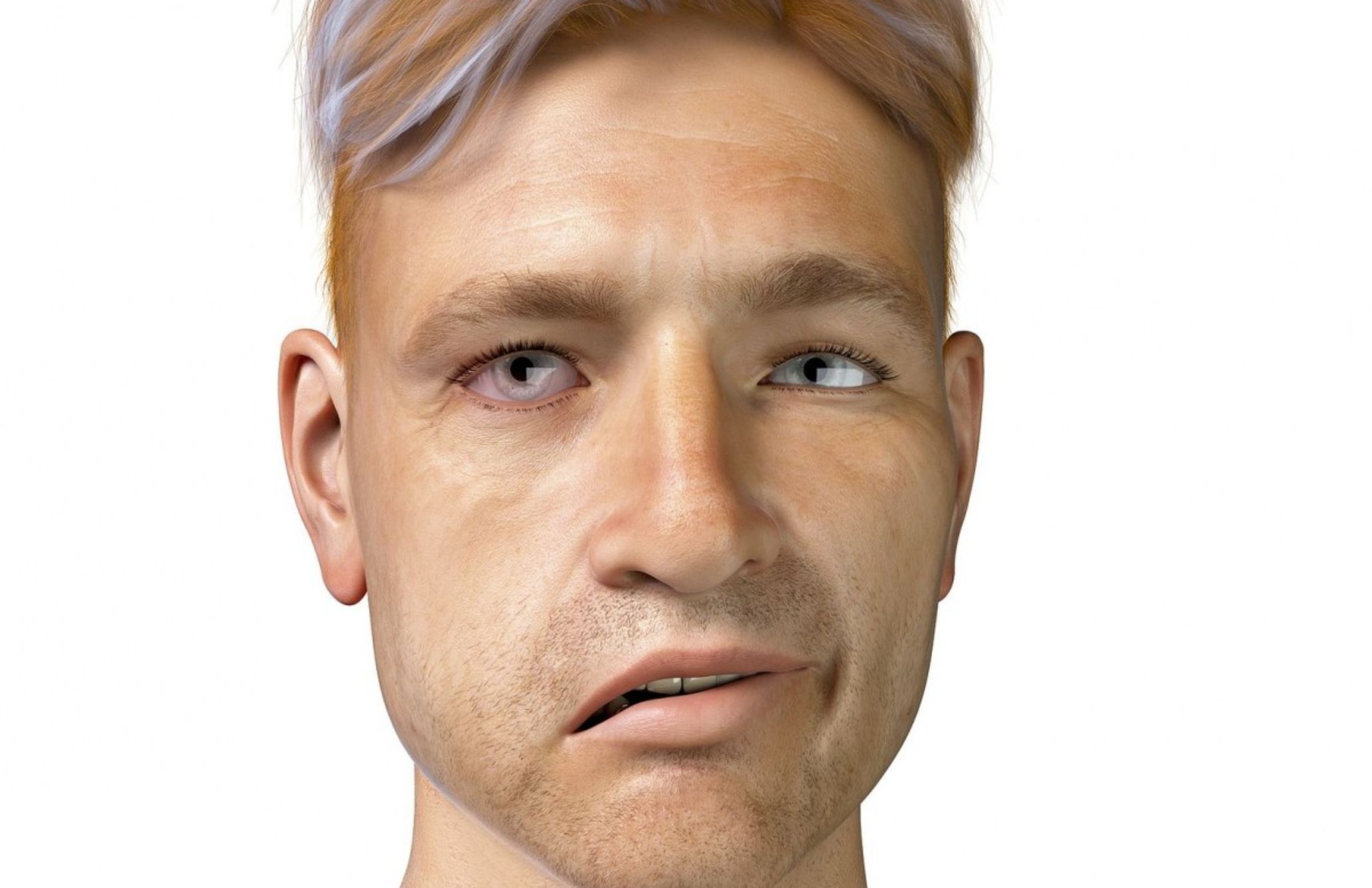 Πάρεση προσώπου: Τι μπορεί να την προκαλέσει και ποια τα συμπτώματα