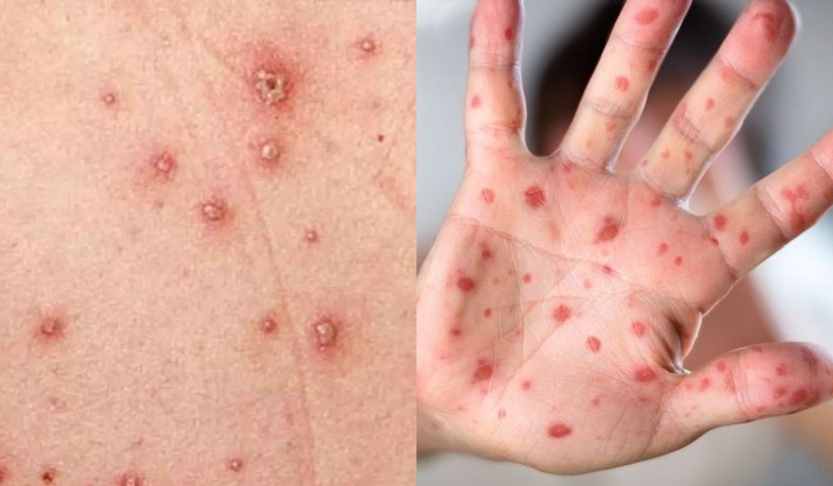 Ιλαρά και στρεπτόκοκκος επέστρεψαν :  Μεγάλη προσοχή σε βρέφη και παιδιά