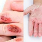 Εγκαύματα στα παιδιά: Η σωστή αντιμετώπιση τους και οι πρώτες βοήθειες