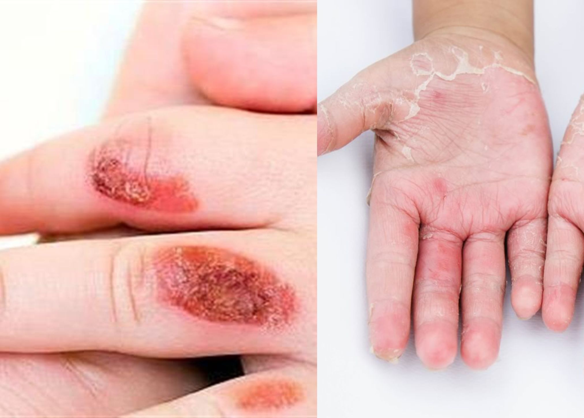 Εγκαύματα στα παιδιά: Η σωστή αντιμετώπιση τους και οι πρώτες βοήθειες