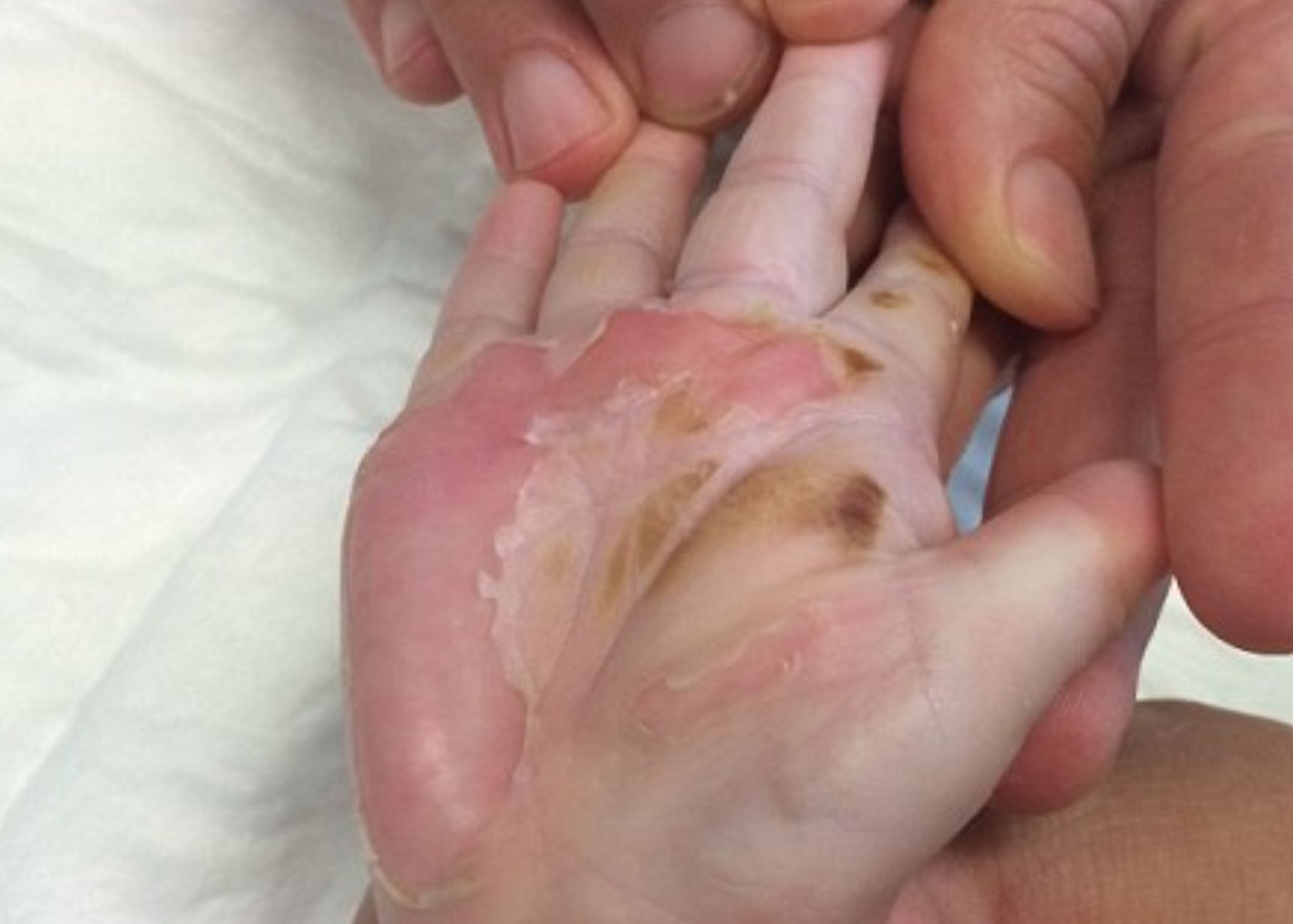 Εγκαύματα στα παιδιά: Η σωστή αντιμετώπιση τους και οι πρώτες βοήθειες