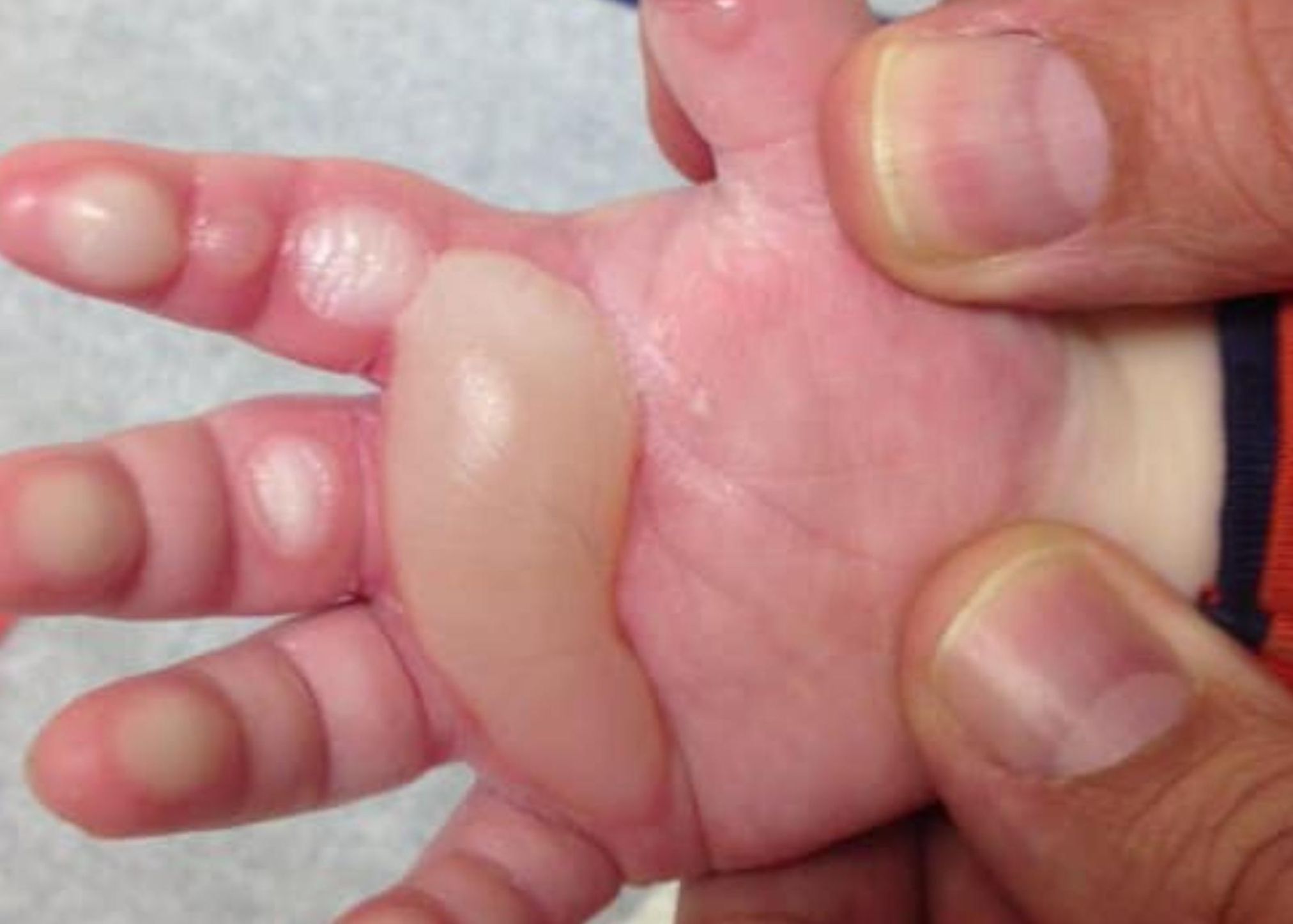 Εγκαύματα στα παιδιά: Η σωστή αντιμετώπιση τους και οι πρώτες βοήθειες