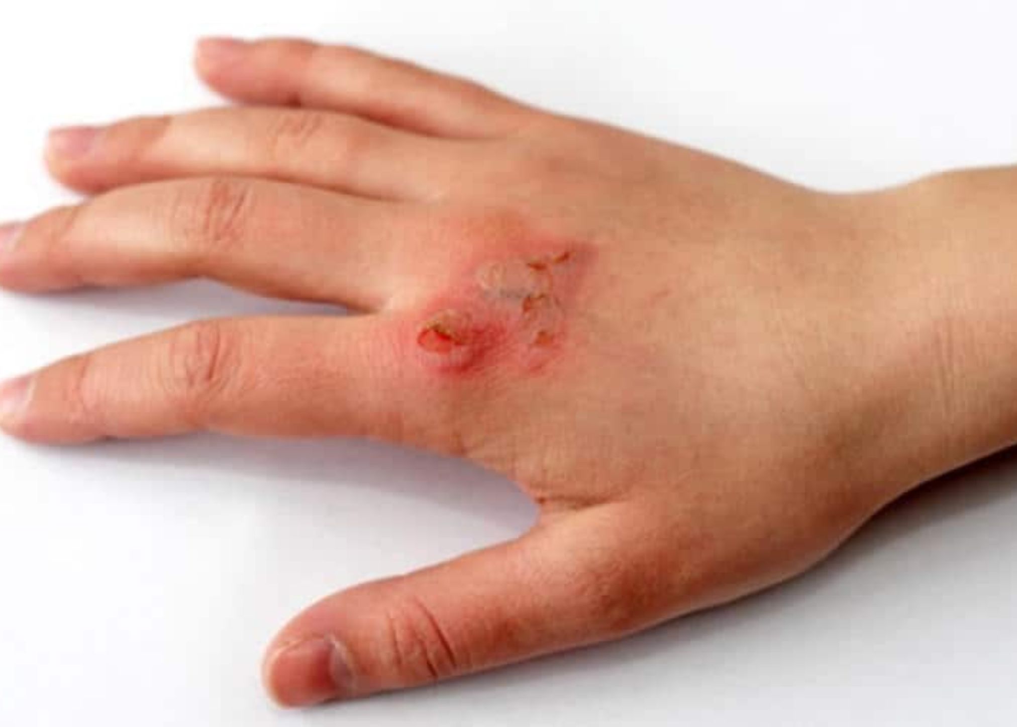 Εγκαύματα στα παιδιά: Η σωστή αντιμετώπιση τους και οι πρώτες βοήθειες