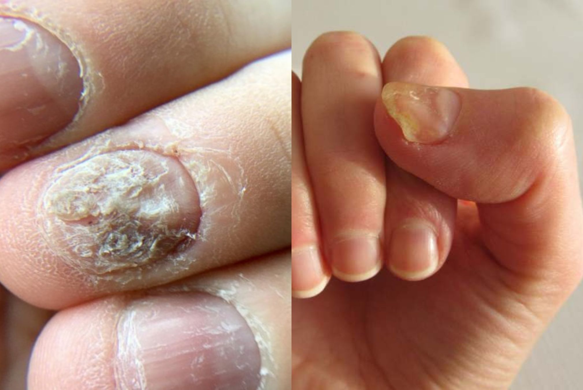 Ονυχομυκητίαση: Τι είναι ποια τα συμπτώματα και ποια η θεραπεία