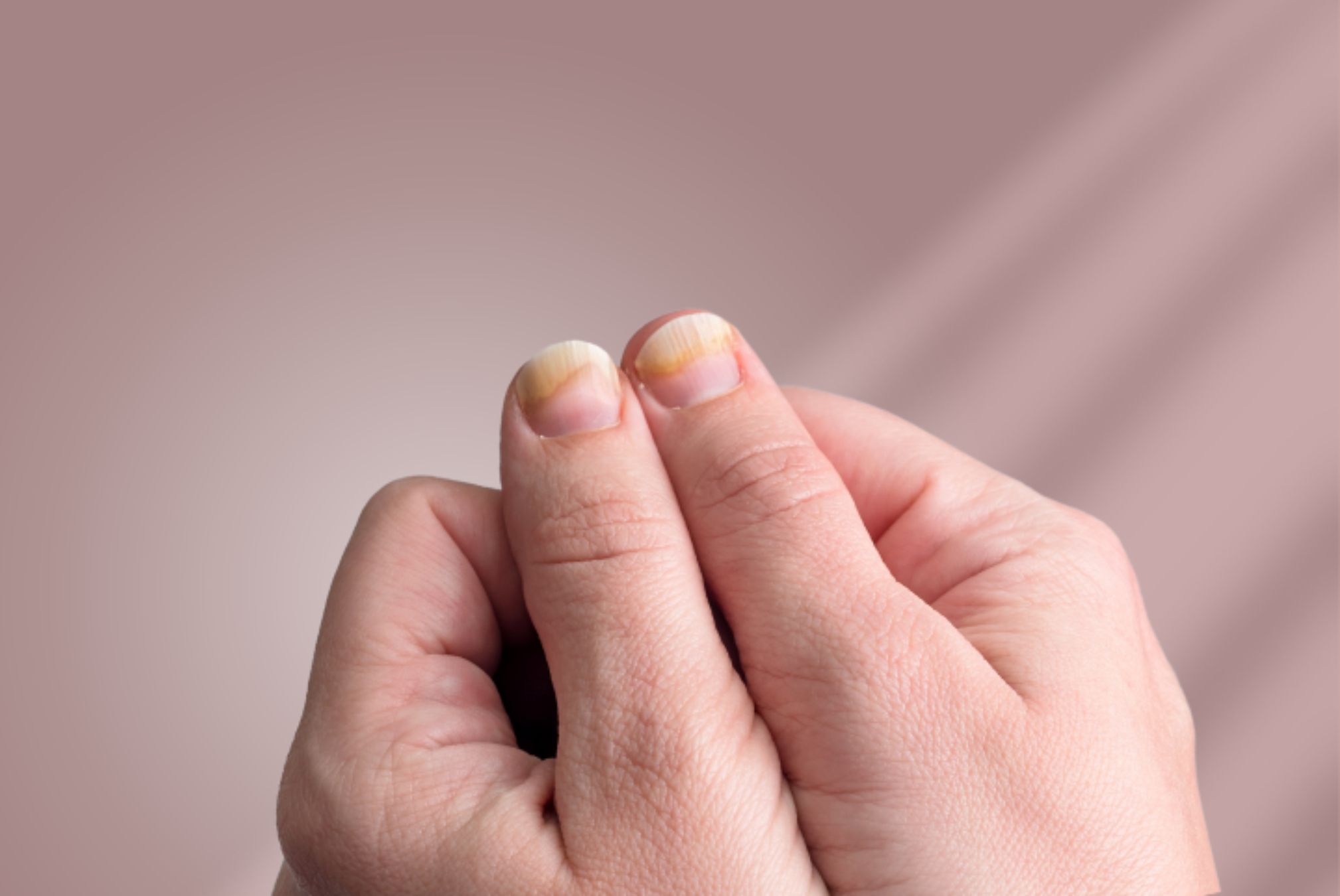 Ονυχομυκητίαση: Τι είναι ποια τα συμπτώματα και ποια η θεραπεία