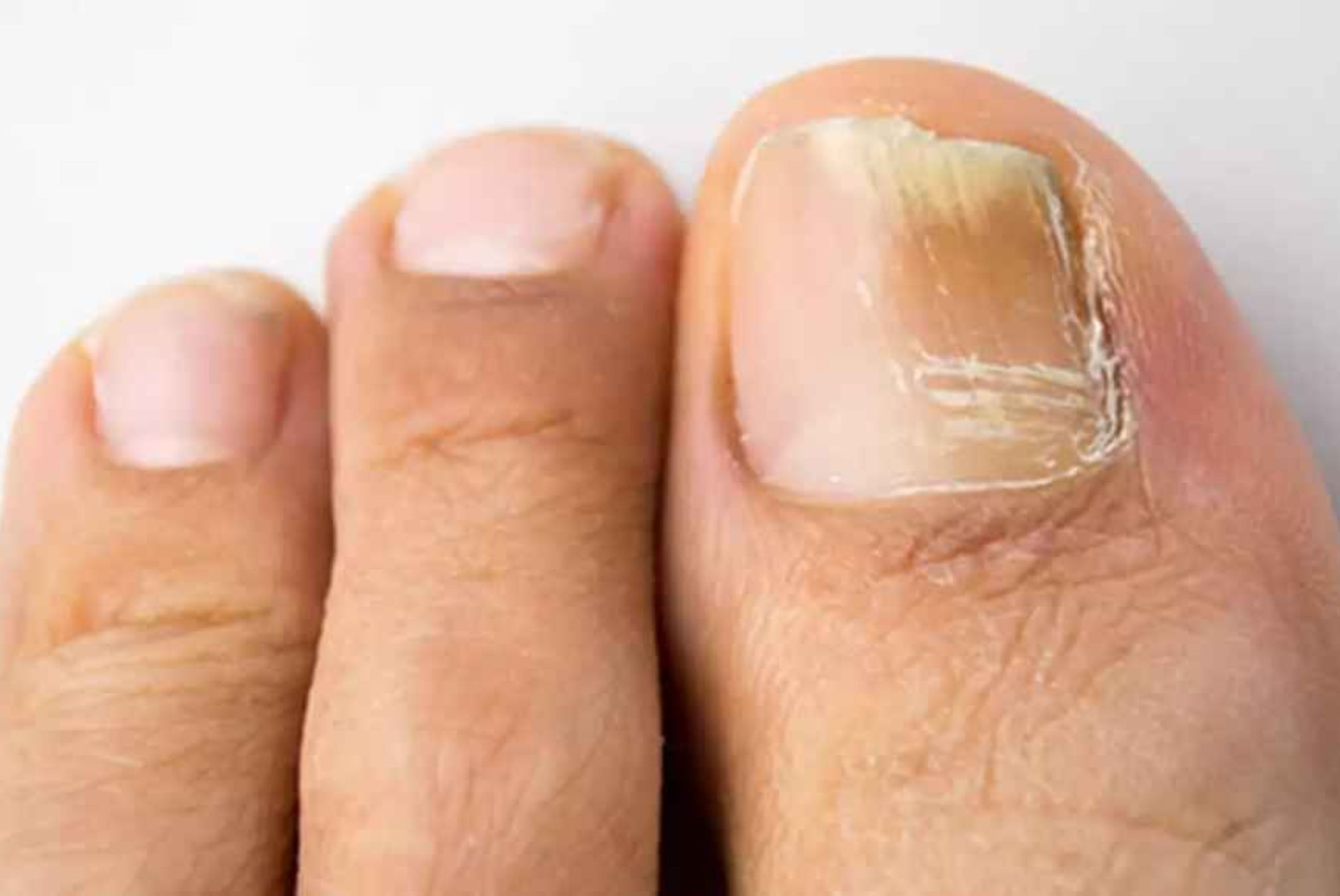 Ονυχομυκητίαση: Τι είναι ποια τα συμπτώματα και ποια η θεραπεία