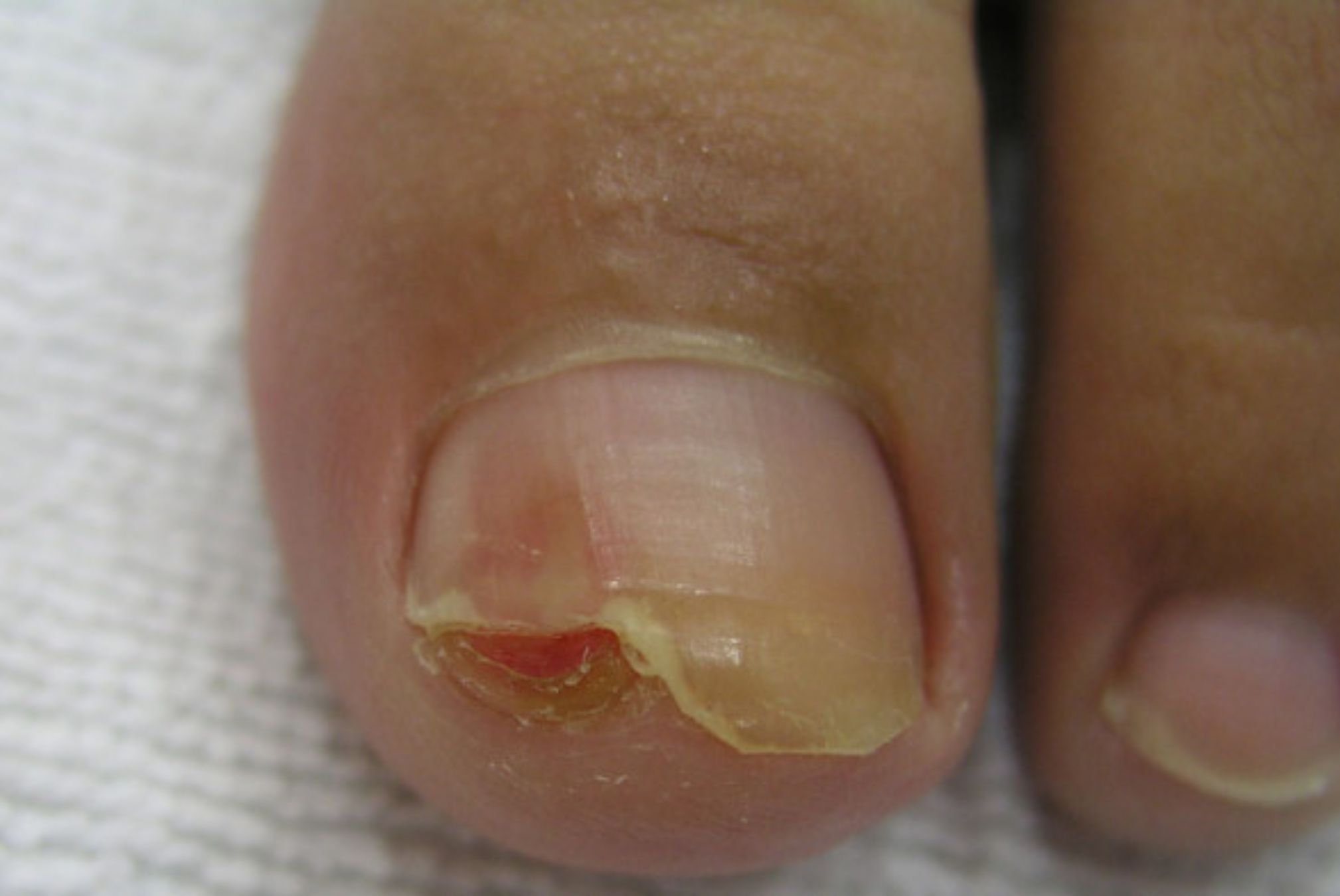 Ονυχομυκητίαση: Τι είναι ποια τα συμπτώματα και ποια η θεραπεία