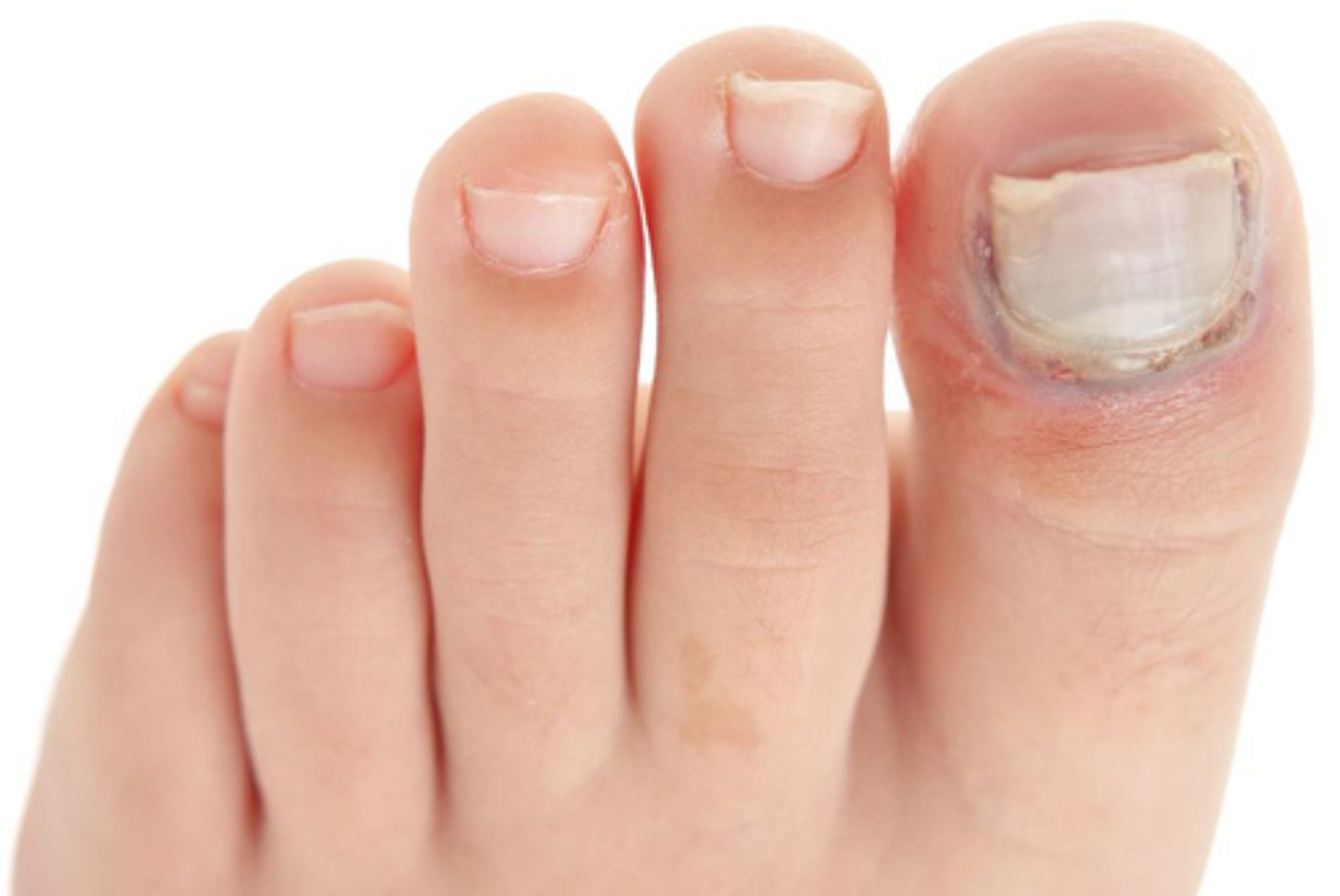 Ονυχομυκητίαση: Τι είναι ποια τα συμπτώματα και ποια η θεραπεία