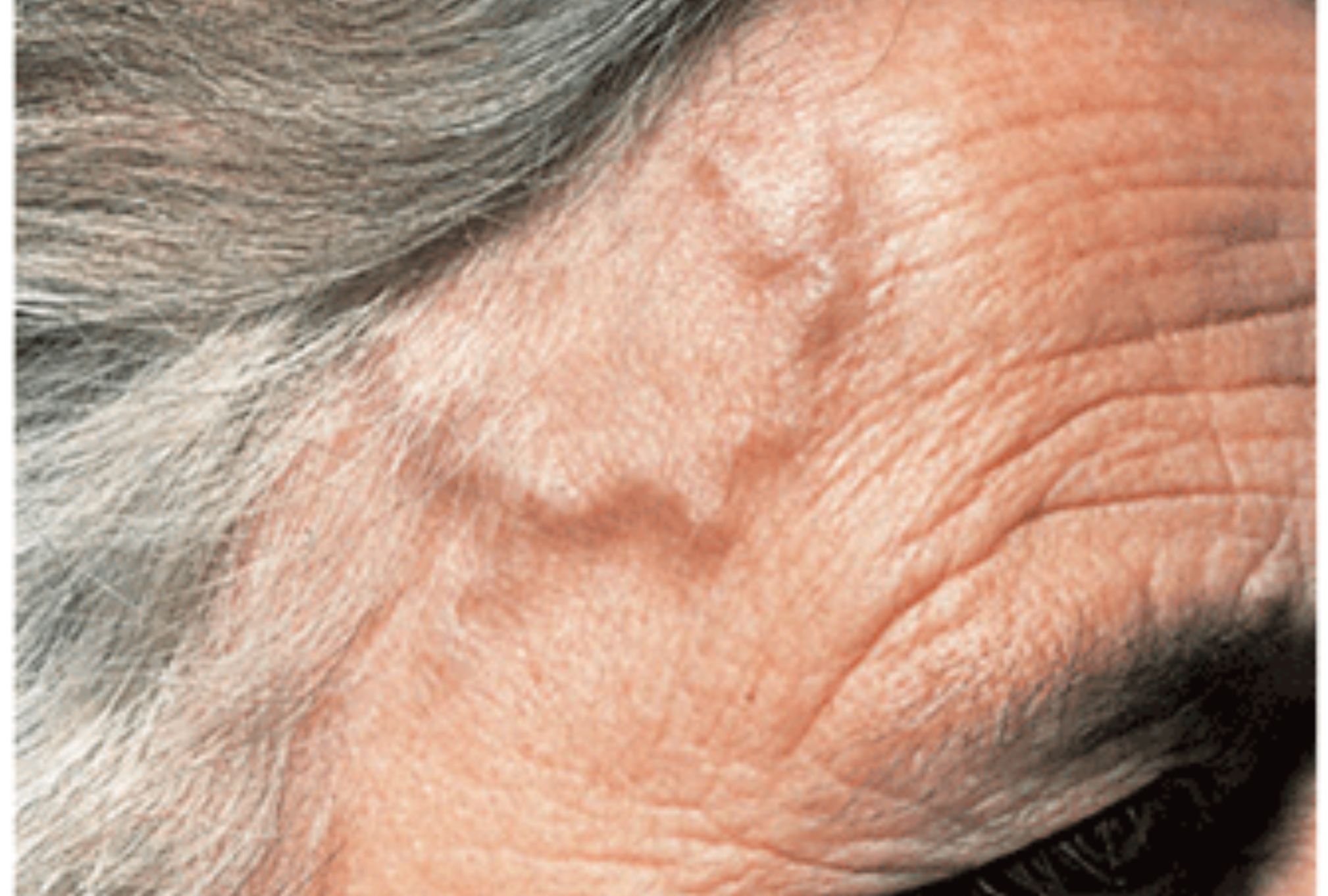 Γιγαντοκυτταρική αρτηρίτιδα: Τι είναι ποια τα συμπτώματα και ποια η θεραπεία