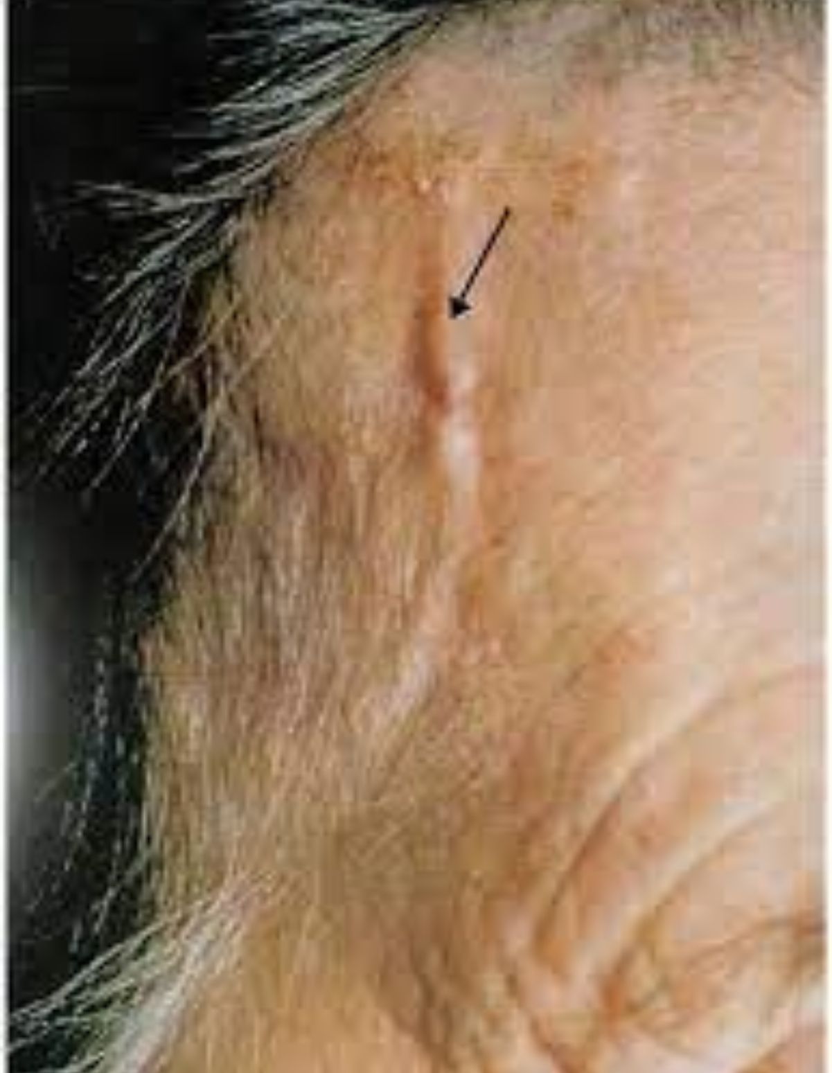 Γιγαντοκυτταρική αρτηρίτιδα: Τι είναι ποια τα συμπτώματα και ποια η θεραπεία