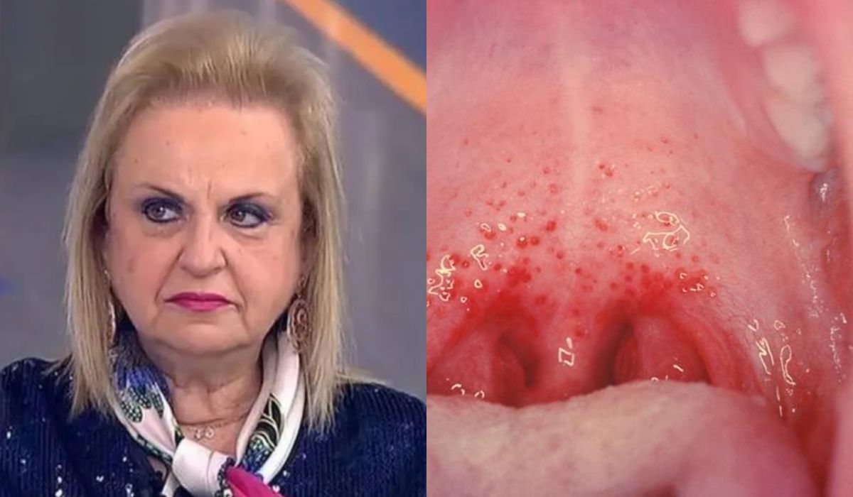 Ματίνα Παγωνη  – Στρεπτόκοκκος : Μεγάλη η ανησυχία – Αυξάνονται ταχύρρυθμα τα κρούσματά