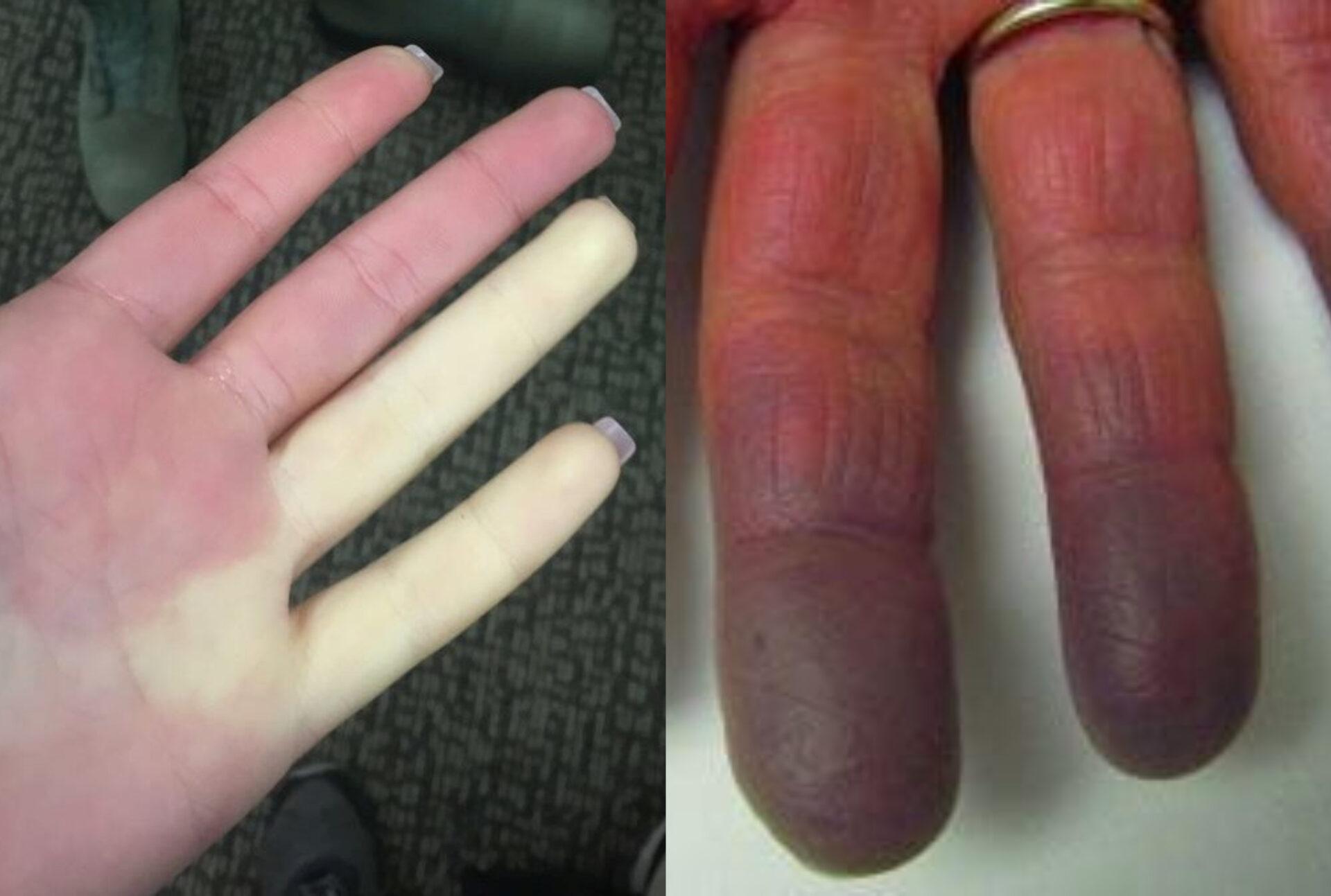 Σύνδρομο Raynaud: Τι είναι ποια τα συμπτώματα και ποια η θεραπεία