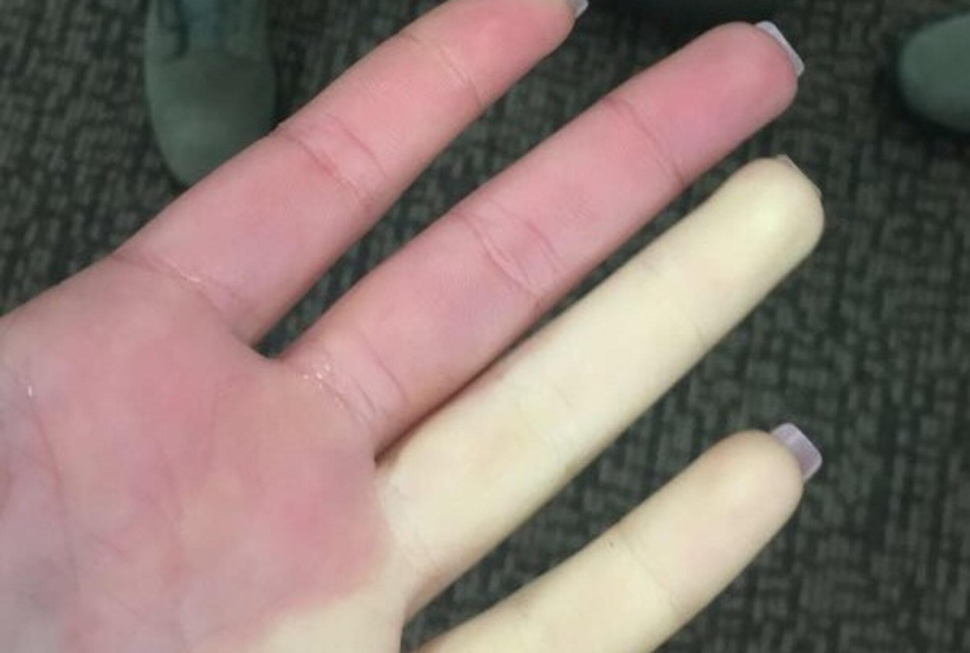 Σύνδρομο Raynaud: Τι είναι ποια τα συμπτώματα και ποια η θεραπεία