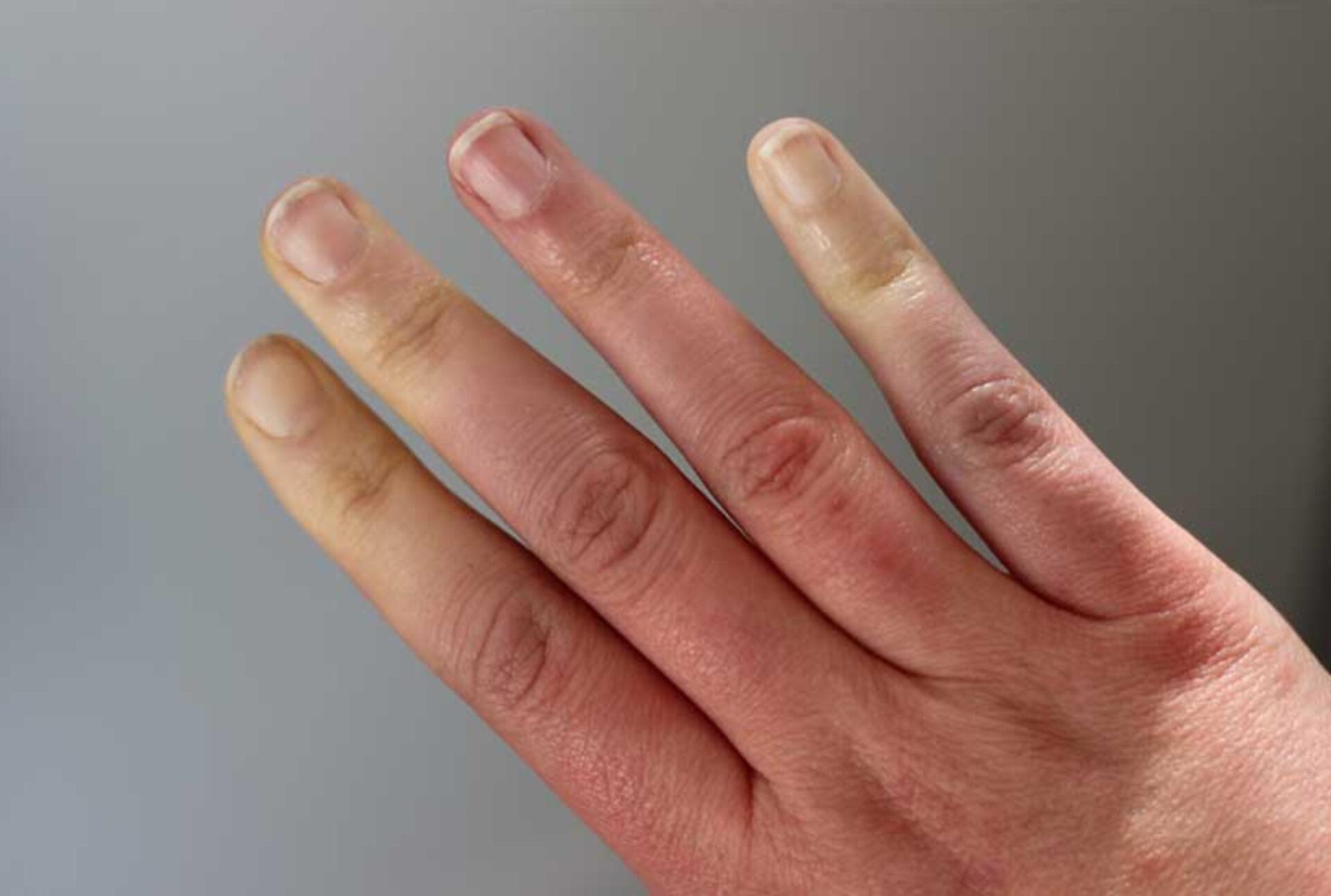 Σύνδρομο Raynaud: Τι είναι ποια τα συμπτώματα και ποια η θεραπεία