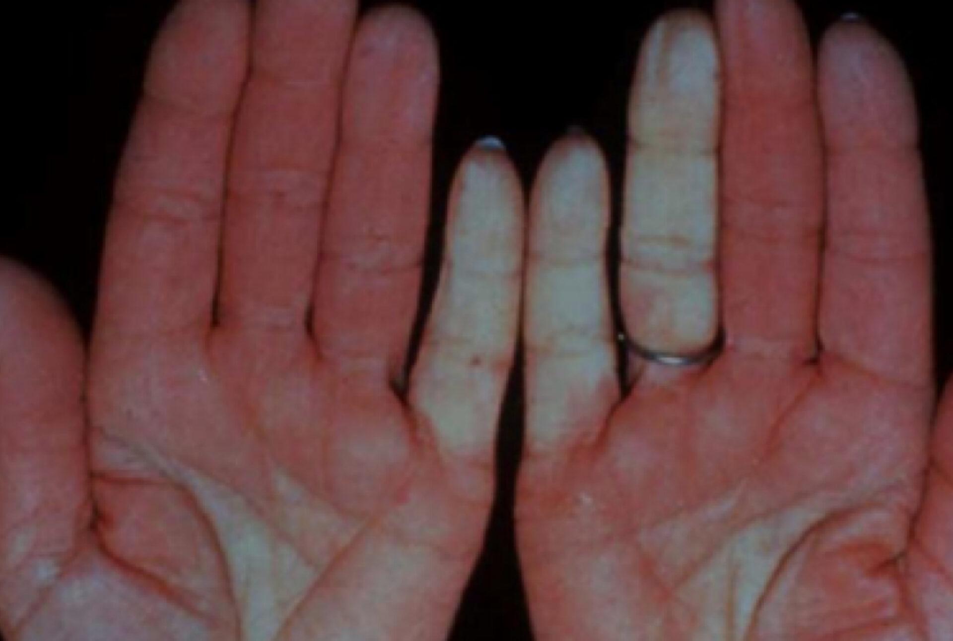 Σύνδρομο Raynaud: Τι είναι ποια τα συμπτώματα και ποια η θεραπεία