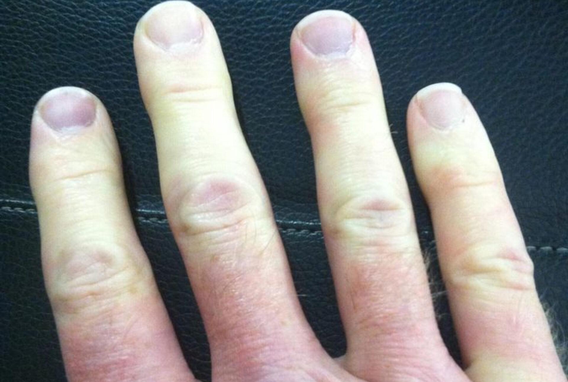 Σύνδρομο Raynaud: Τι είναι ποια τα συμπτώματα και ποια η θεραπεία