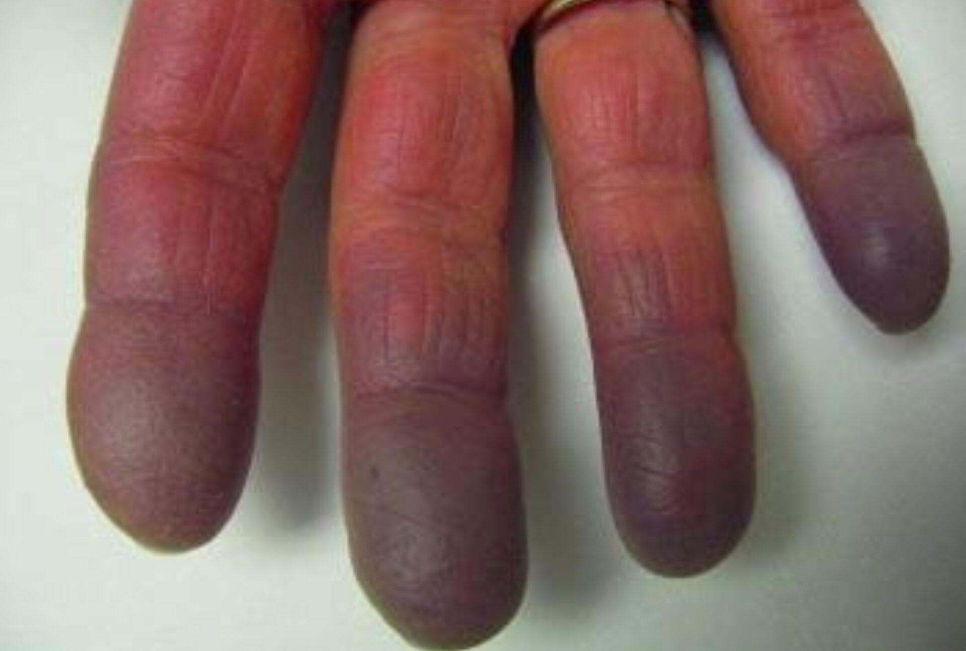 Σύνδρομο Raynaud: Τι είναι ποια τα συμπτώματα και ποια η θεραπεία