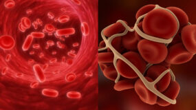 Αιμορροφιλία: Τι είναι ποια τα συμπτώματα και ποια η θεραπεία