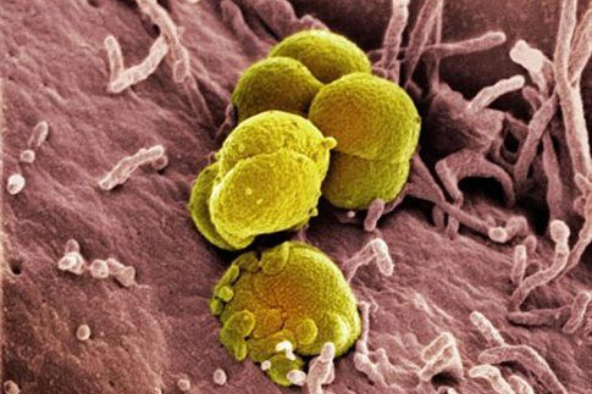 Γονοκκοκική λοίμωξη ή γονόρροια: Πώς μεταδίδεται τι συμπτώματα έχει και ποια η θεραπεία