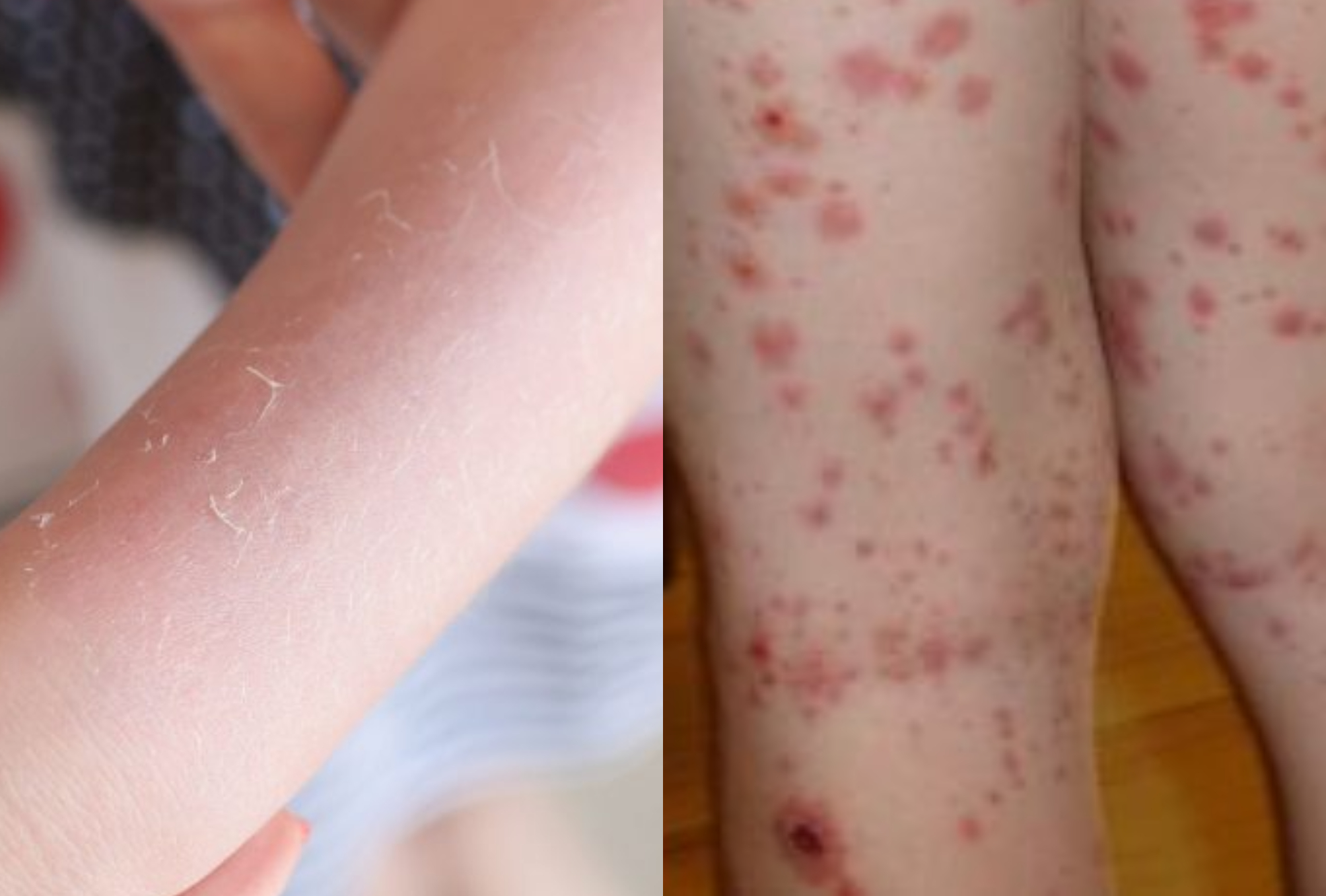 Αλλεργική πορφύρα στα παιδιά: Τι είναι ποια τα συμπτώματα και ποια η θεραπεία