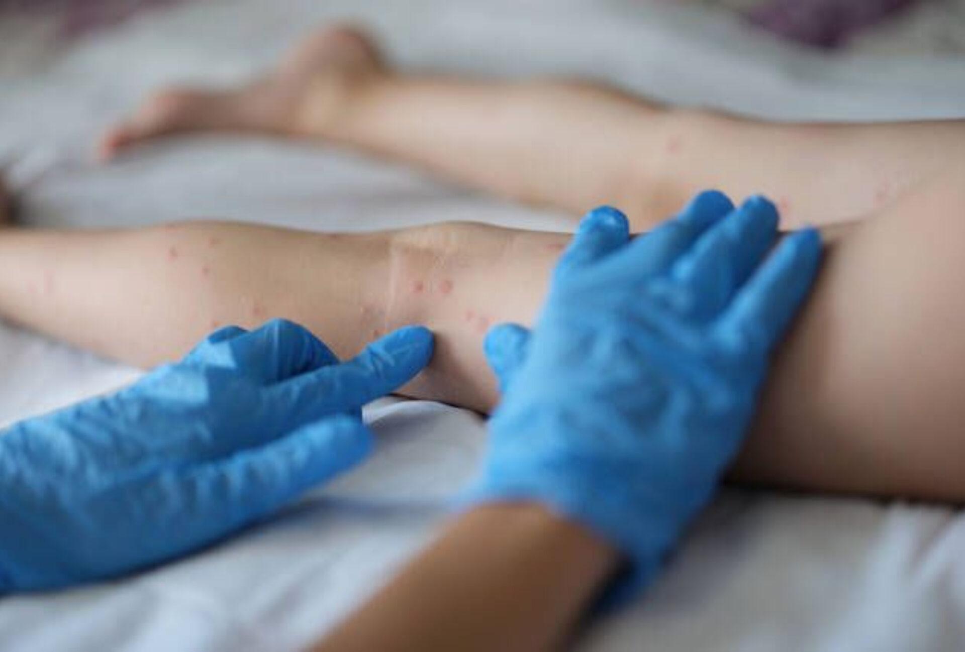 Αλλεργική πορφύρα στα παιδιά: Τι είναι ποια τα συμπτώματα και ποια η θεραπεία