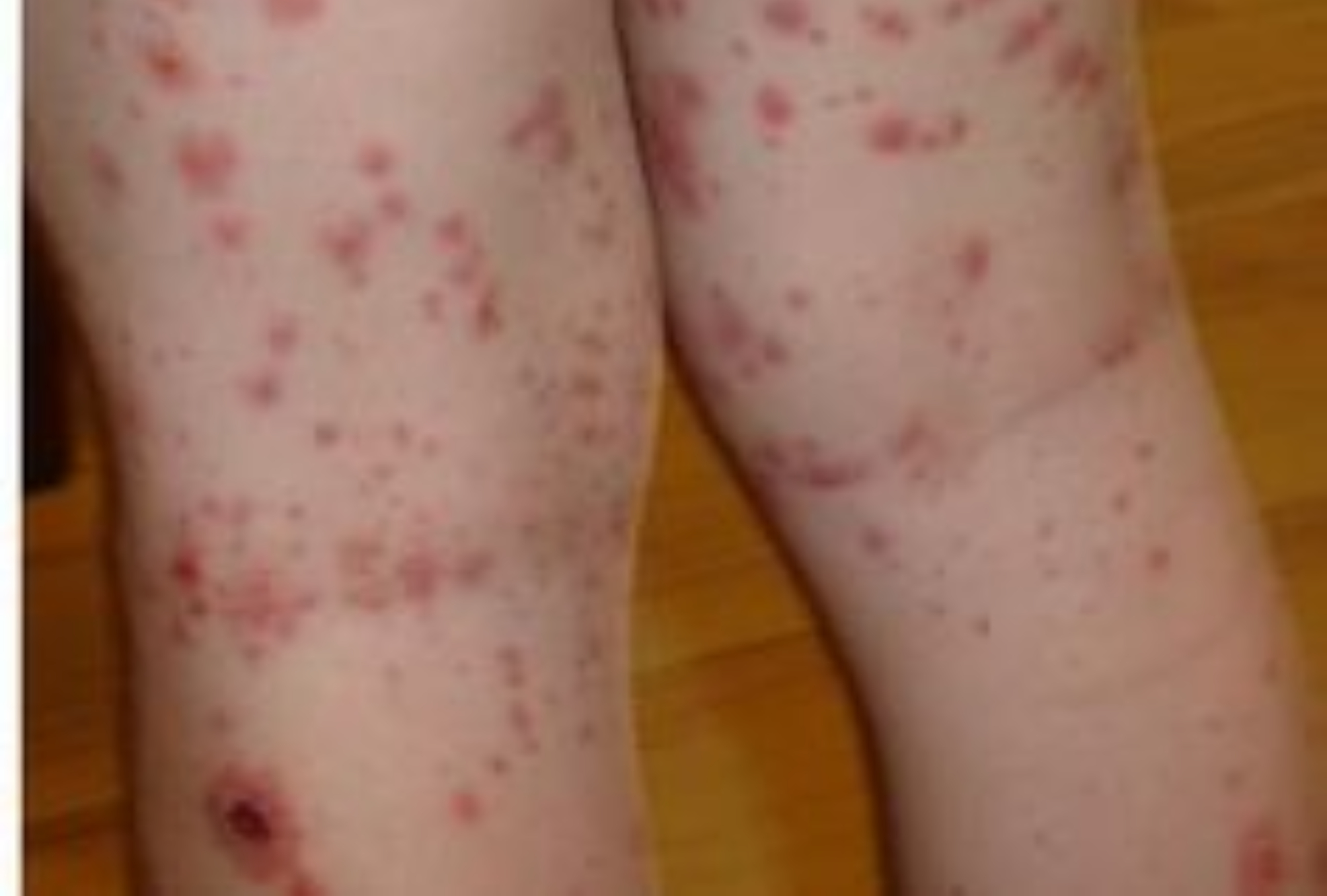 Αλλεργική πορφύρα στα παιδιά: Τι είναι ποια τα συμπτώματα και ποια η θεραπεία