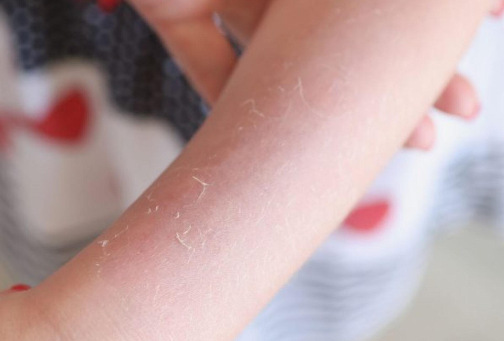 Αλλεργική πορφύρα στα παιδιά: Τι είναι ποια τα συμπτώματα και ποια η θεραπεία