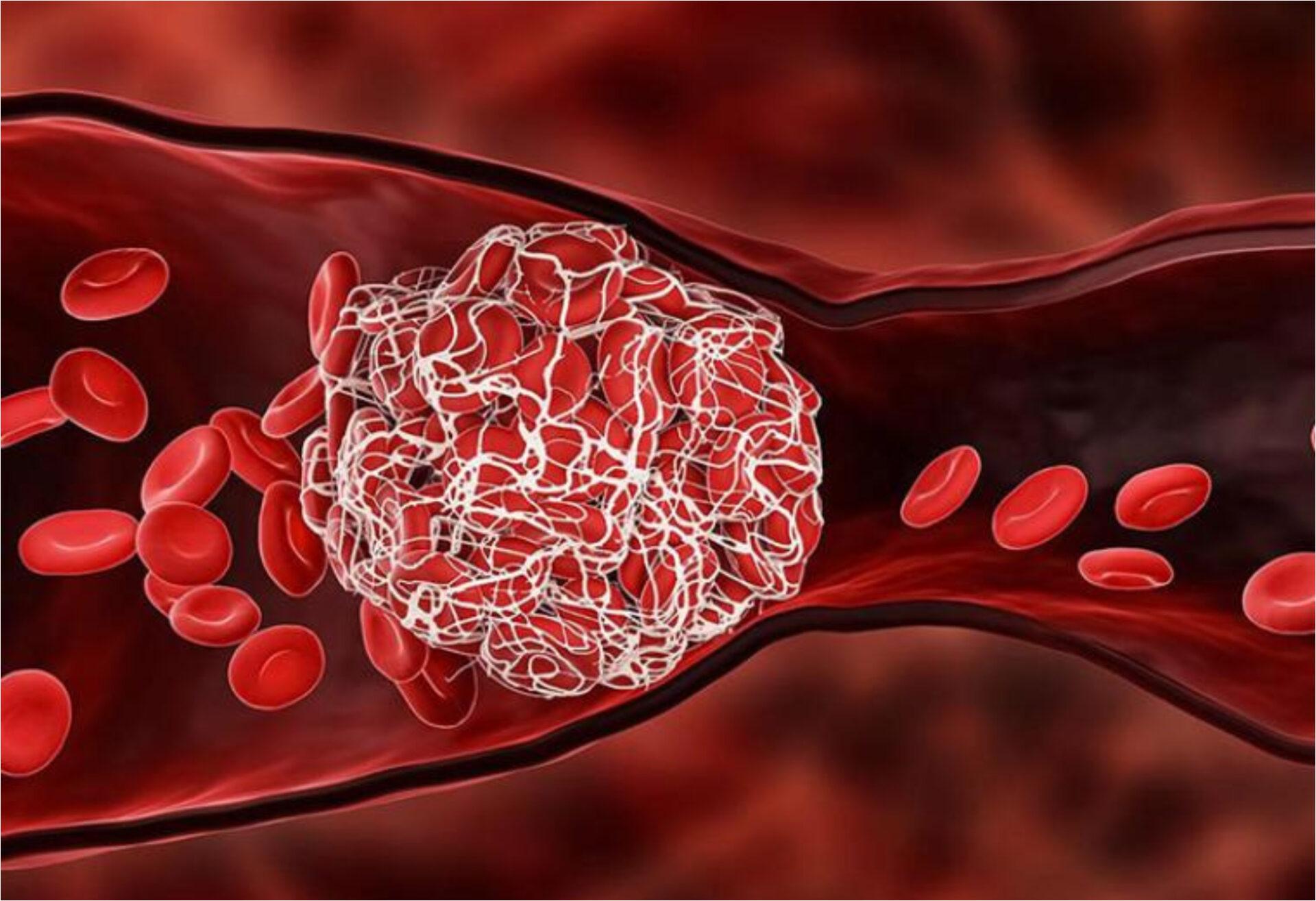 Θρομβοφιλία στα παιδιά: Τι είναι πως εκδηλώνεται και ποια η θεραπεία