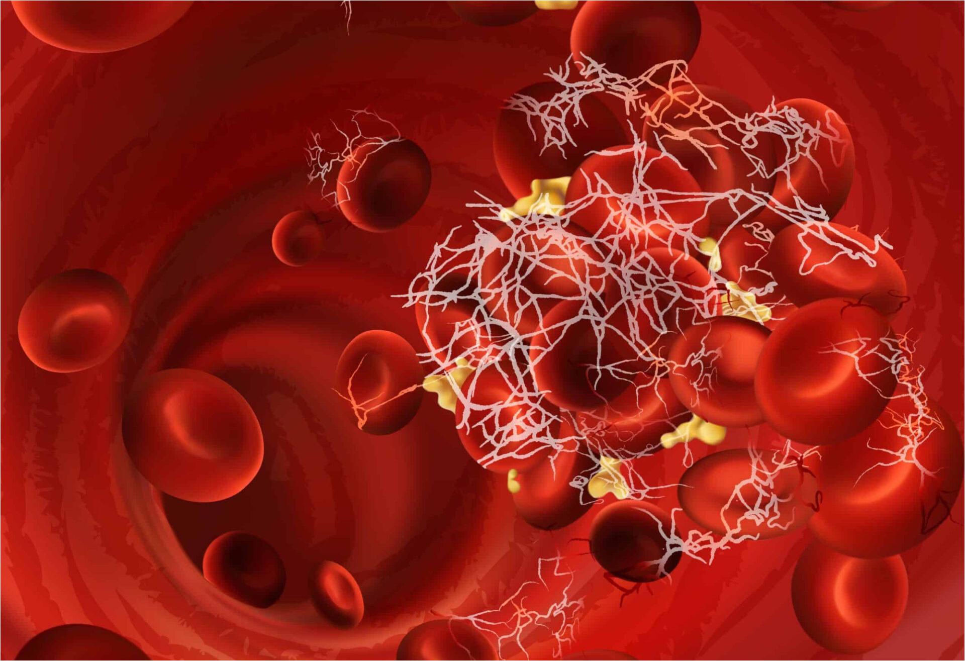 Θρομβοφιλία στα παιδιά: Τι είναι πως εκδηλώνεται και ποια η θεραπεία