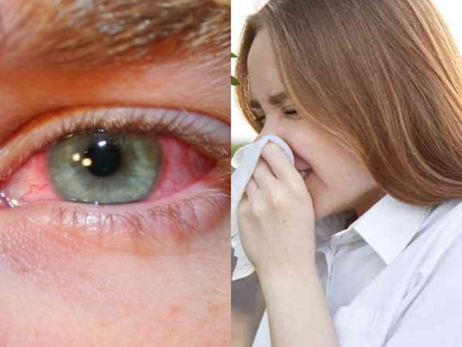 αλλεργία-στη-γύρη-συμπτώματα-αντιμετώπιση-αίτια-