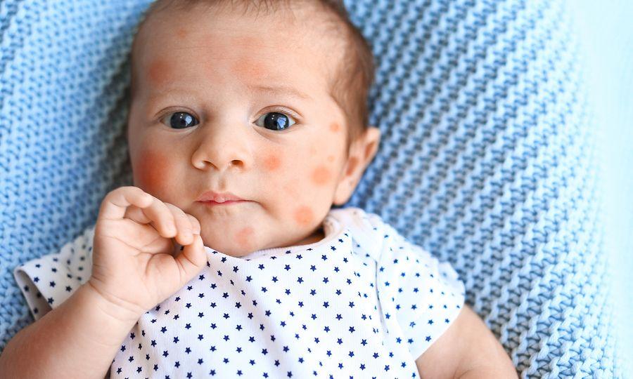 οι-πιο-συχνές-αλλεργίες-στα-παιδιά- οι-πιο-συχνές-αλλεργίες-στα-παιδιά-