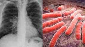 Έξαρση φυματίωσης: Τι είναι ποια τα συμπτώματα και ποια η θεραπεία