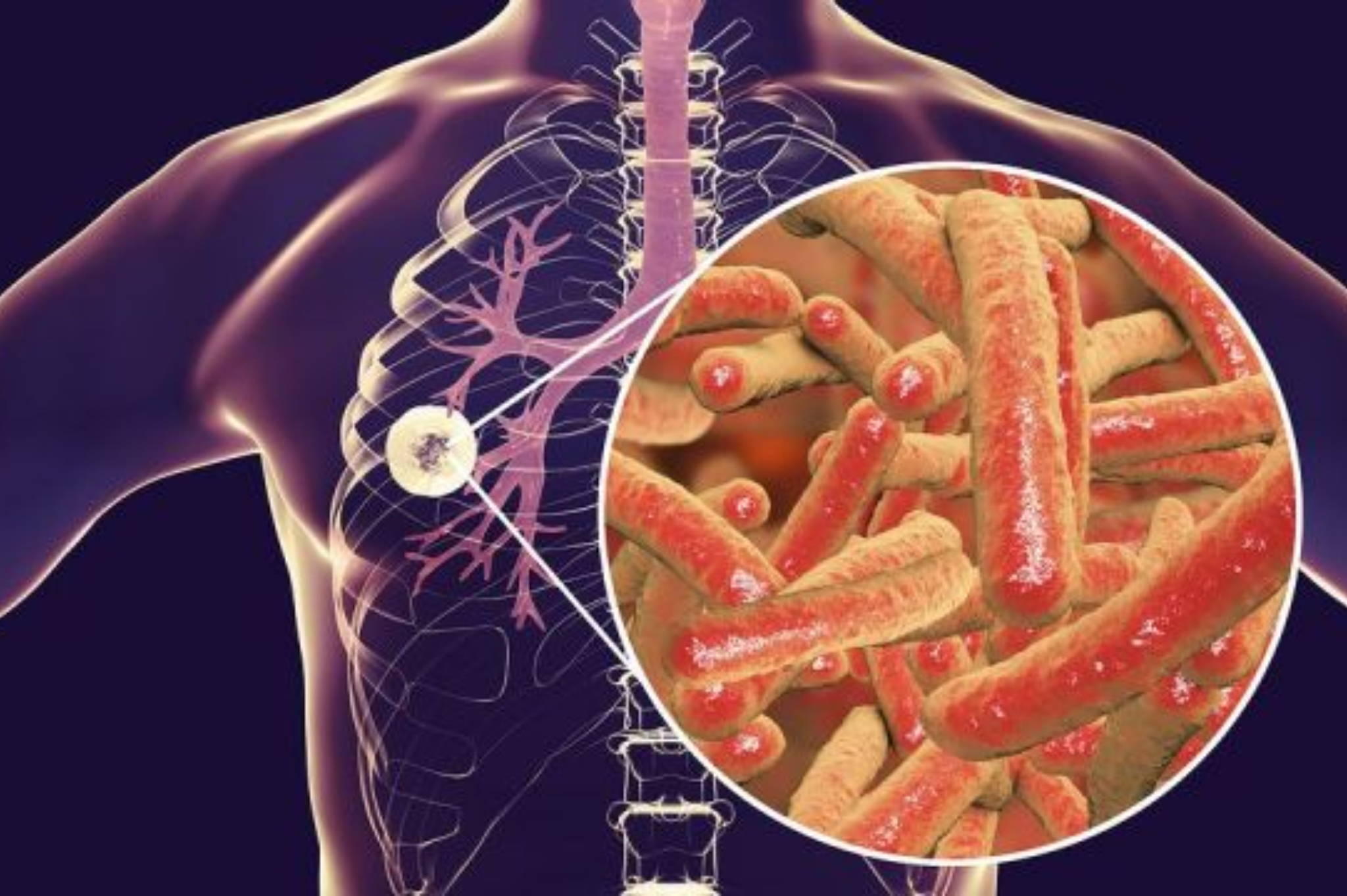 Έξαρση φυματίωσης: Τι είναι ποια τα συμπτώματα και ποια η θεραπεία