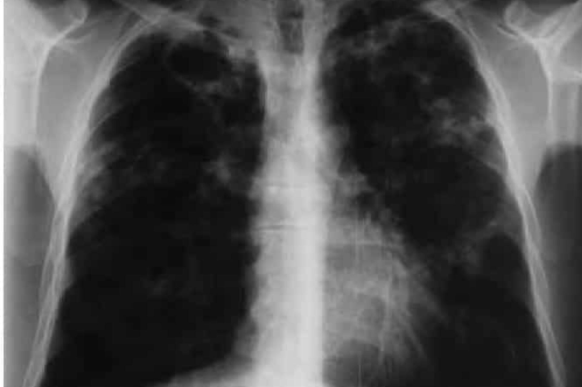 Έξαρση φυματίωσης: Τι είναι ποια τα συμπτώματα και ποια η θεραπεία