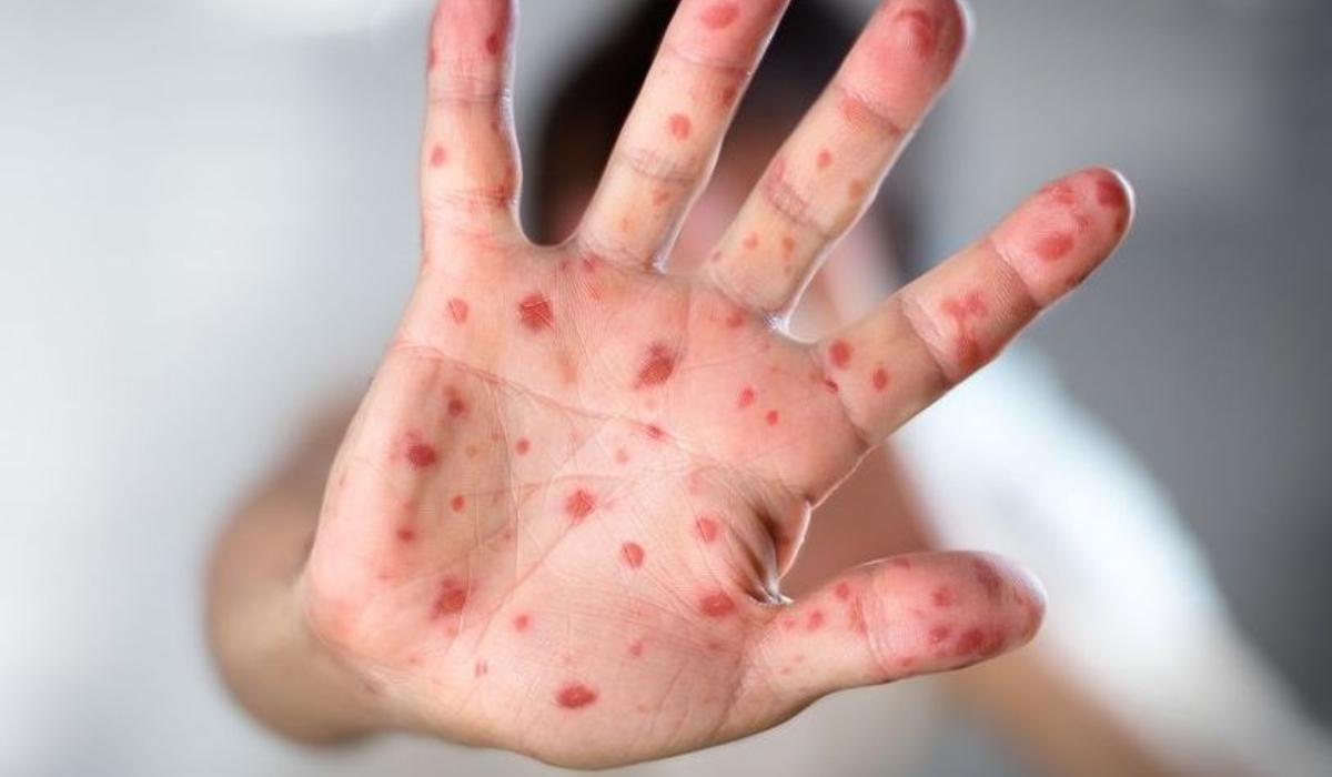 Ιλαρά : Αυξημένα Κρούσματα  σε παιδιά