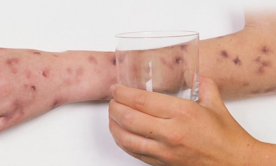 Κεραυνοβόλος μηνιγγίτιδα-συμπτώματα-αίτια-