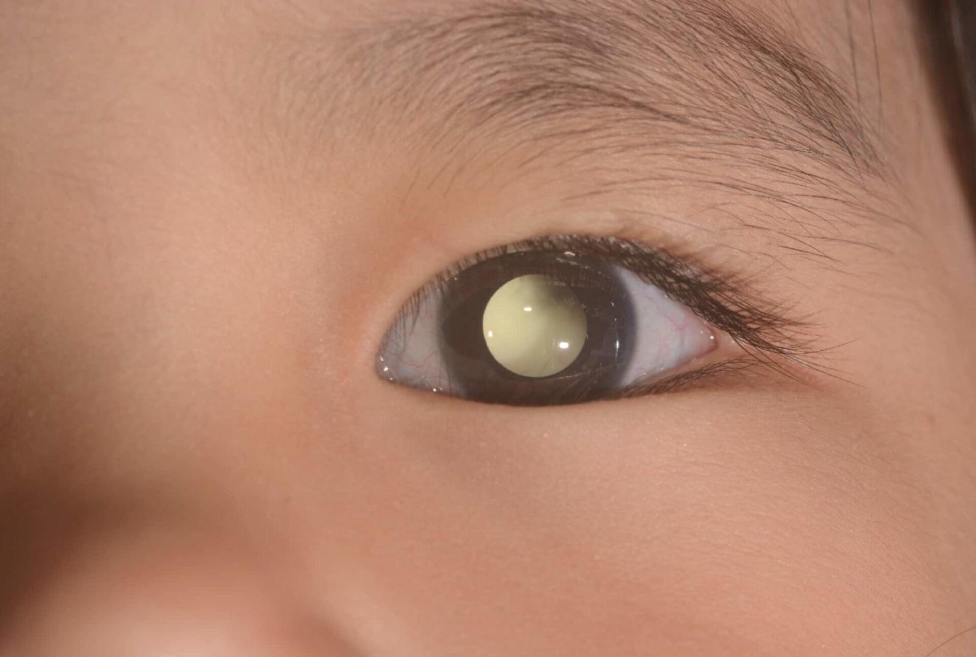 Ρετινοβλάστωμα στα παιδιά: Τι είναι ποια τα συμπτώματα και ποια η θεραπεία