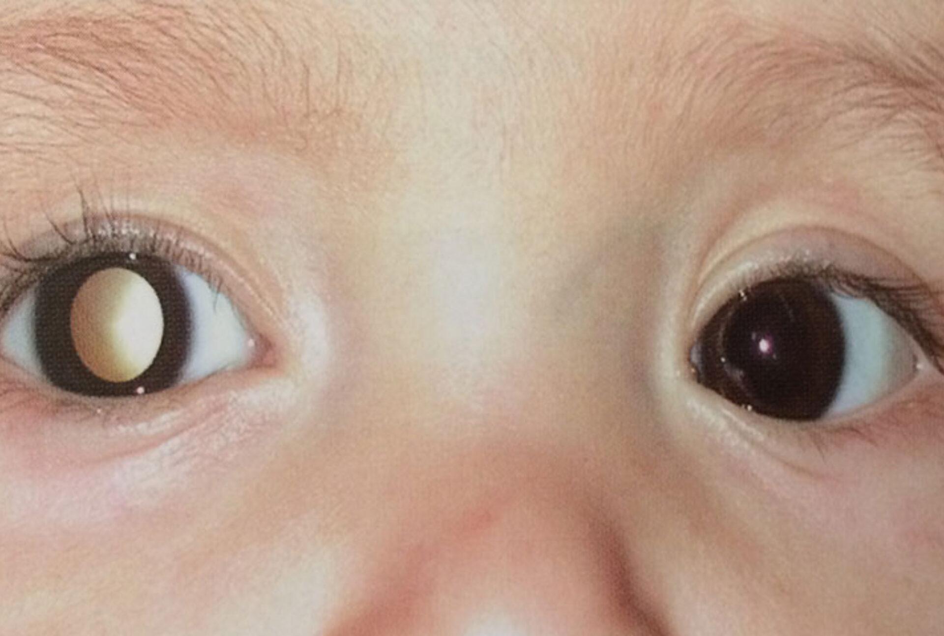 Ρετινοβλάστωμα στα παιδιά: Τι είναι ποια τα συμπτώματα και ποια η θεραπεία