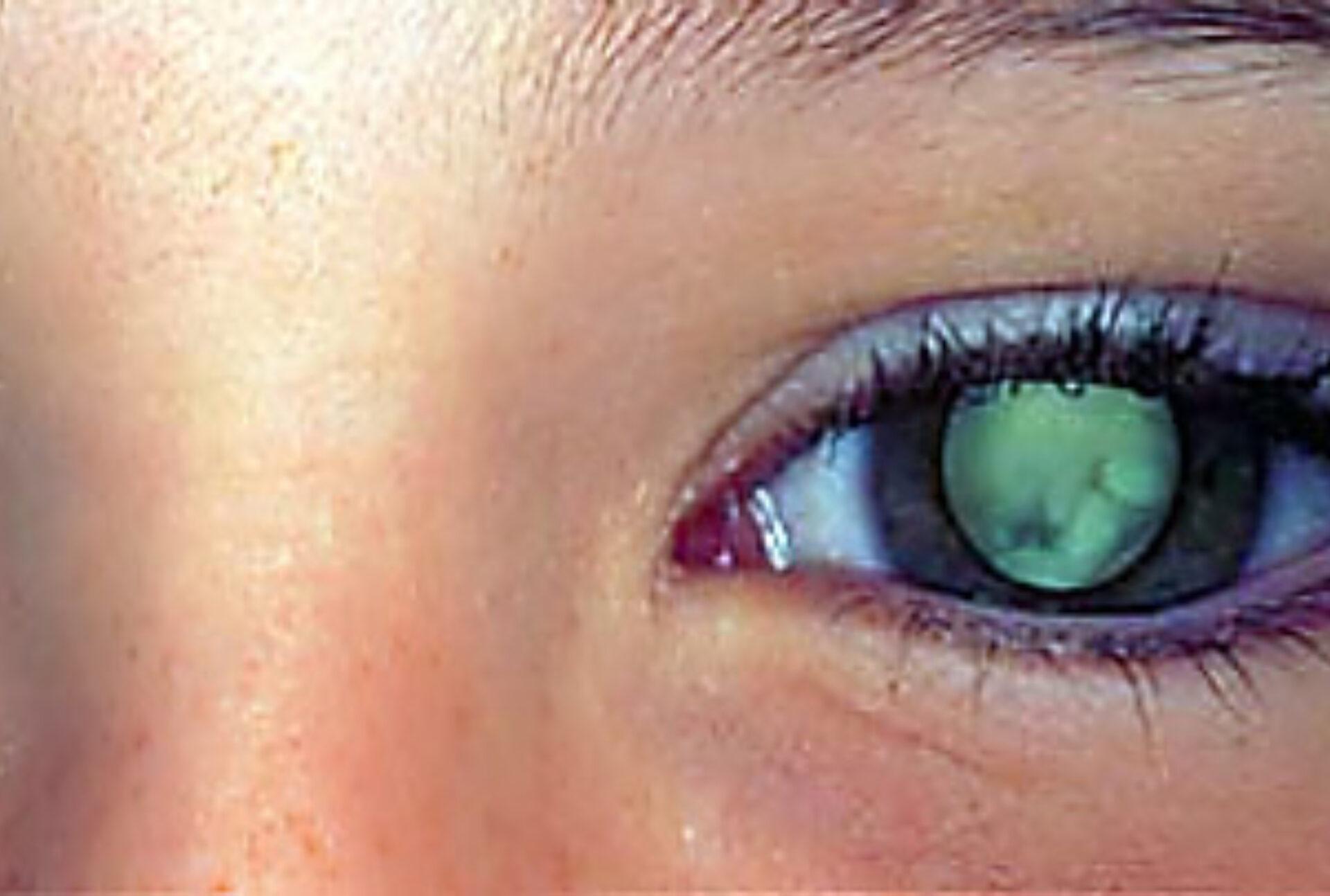 Ρετινοβλάστωμα στα παιδιά: Τι είναι ποια τα συμπτώματα και ποια η θεραπεία