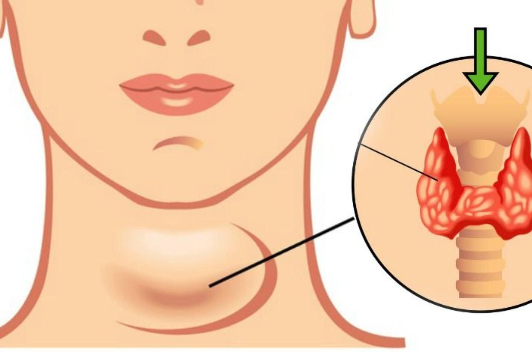 Υποθυρεοειδισμός- Υποθυρεοειδισμός-