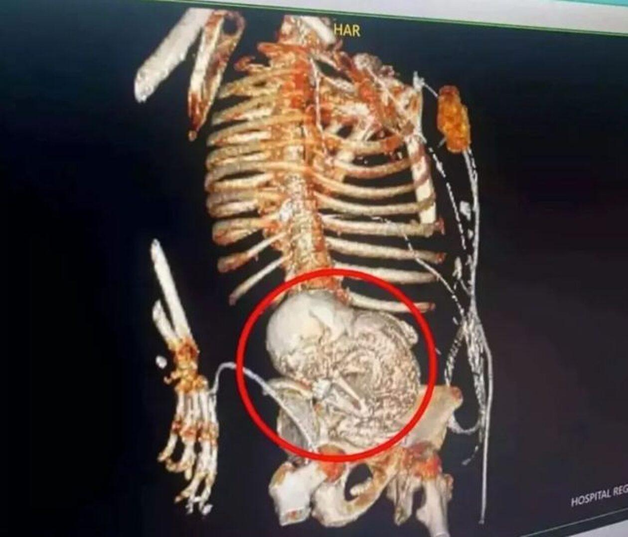 Πίστευαν πως είχε καρκίνο και κυοφορούσε πέτρινο παιδί