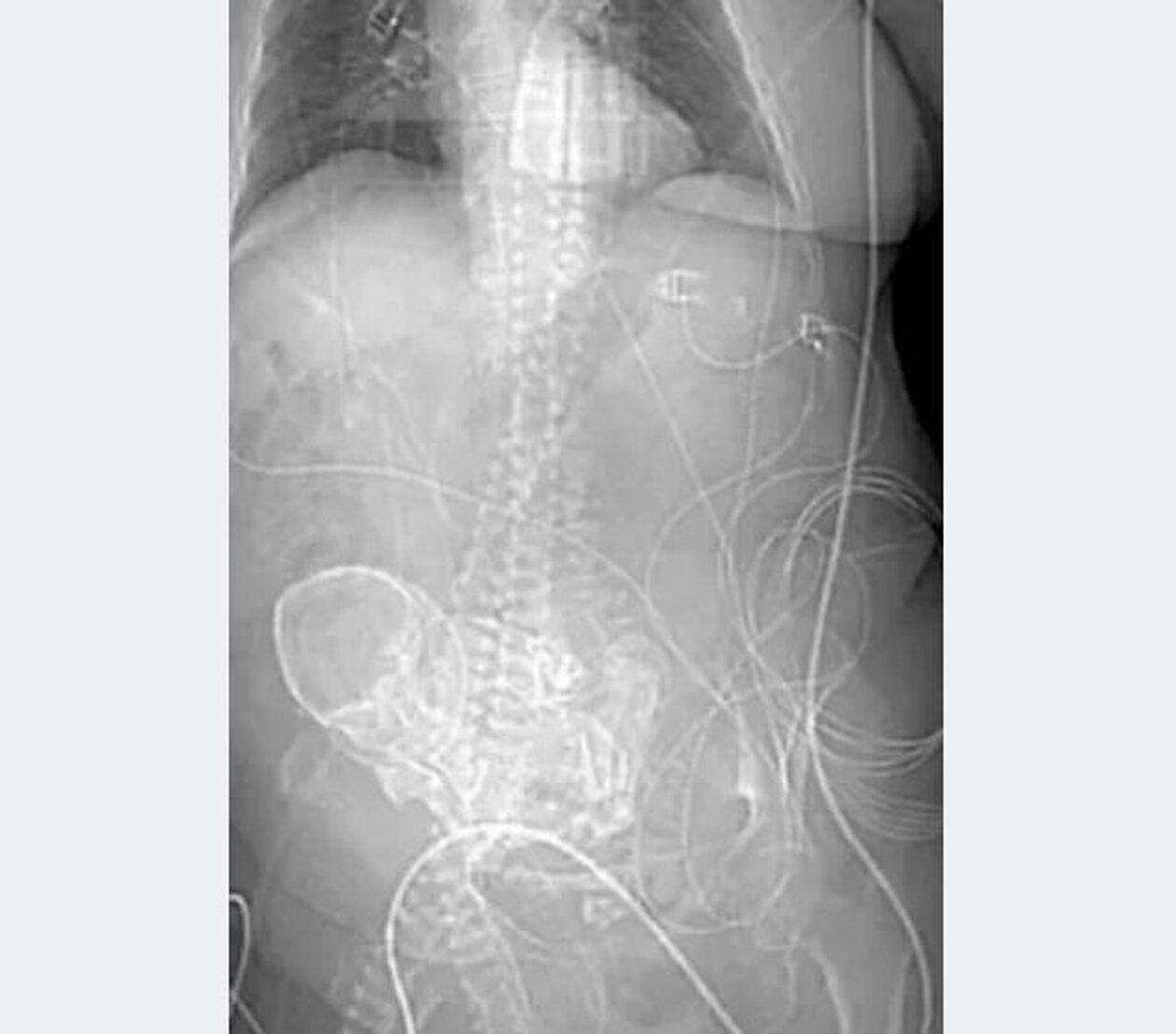 Πίστευαν πως είχε καρκίνο και κυοφορούσε πέτρινο παιδί