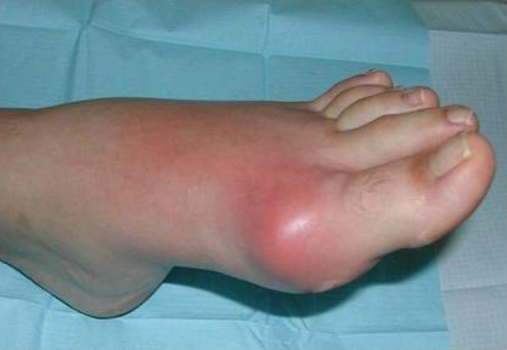 Η νόσος των βασιλιάδων: Τι είναι ποια τα συμπτώματα και ποια η θεραπεία