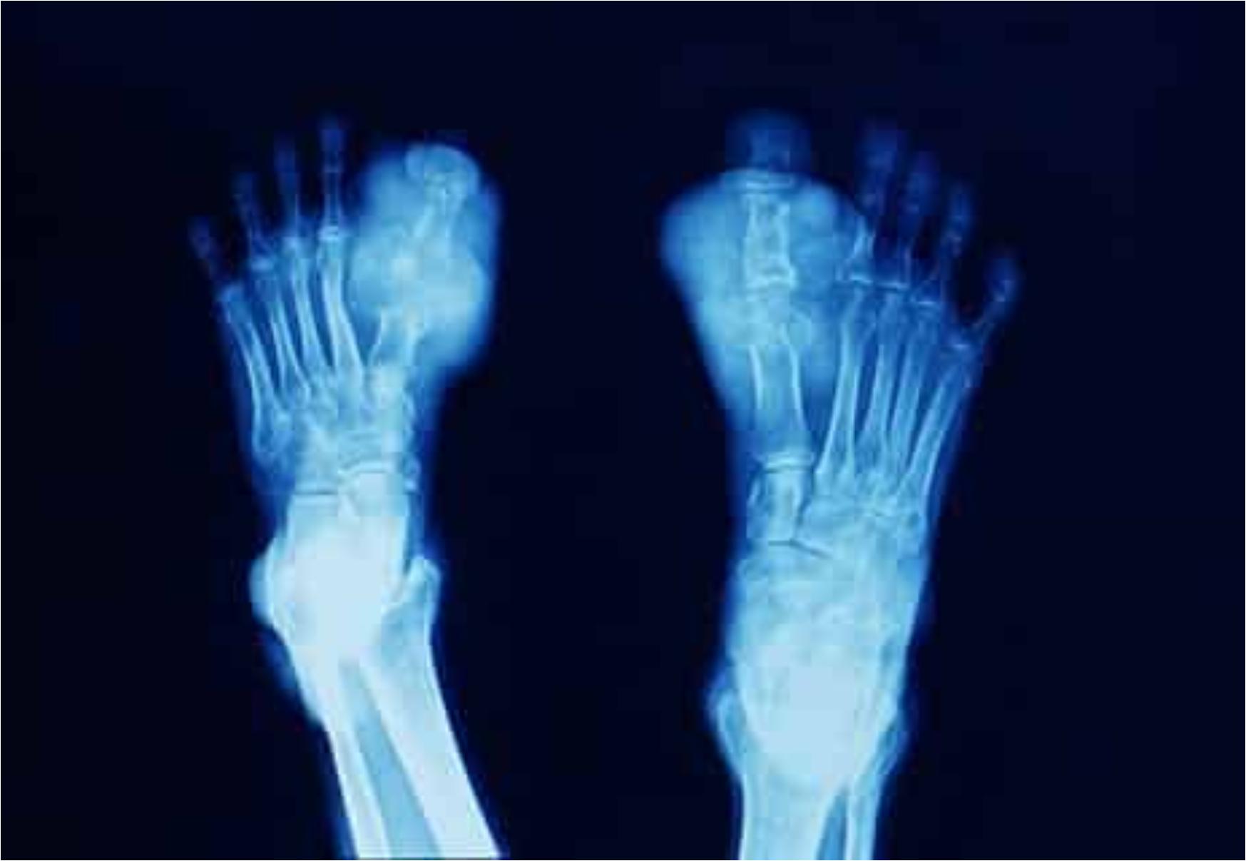 Η νόσος των βασιλιάδων: Τι είναι ποια τα συμπτώματα και ποια η θεραπεία