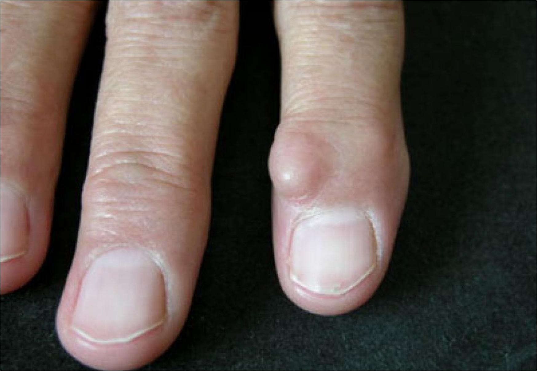 Η νόσος των βασιλιάδων: Τι είναι ποια τα συμπτώματα και ποια η θεραπεία