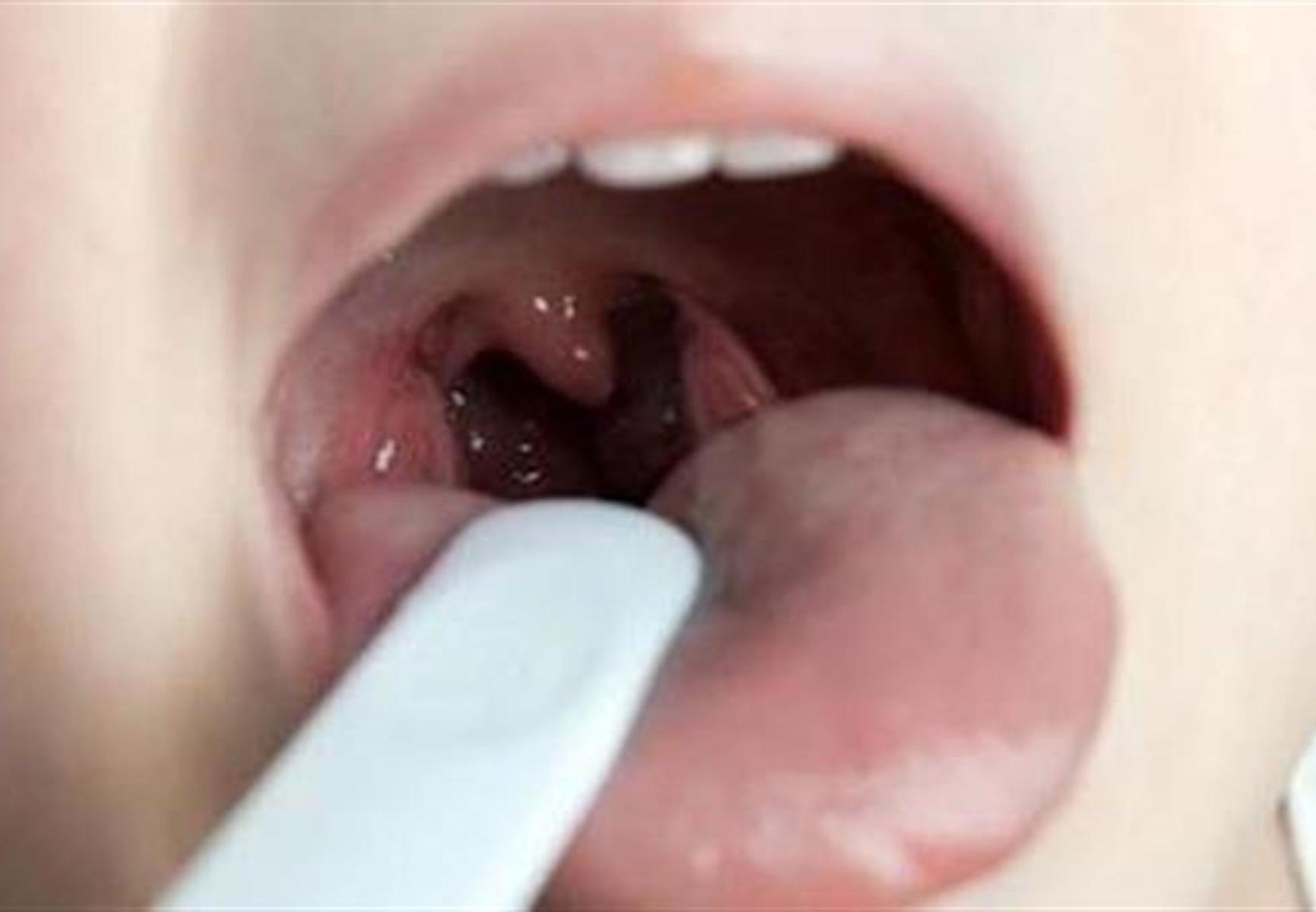 Αμυγδαλές και κρεατάκια στα παιδιά: Τα προβλήματα που δημιουργούν και πότε πρέπει να αφαιρεθούν